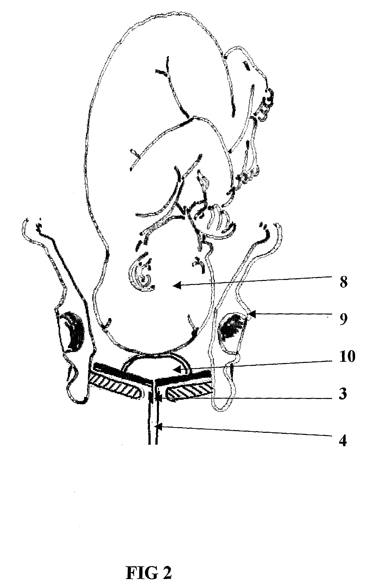 Device to Assist in Cesarean Section