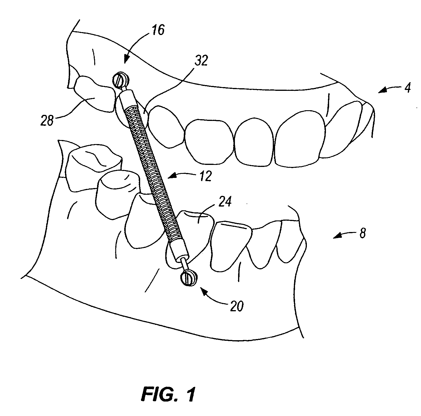 Orthopedic implant for mandibular advancer