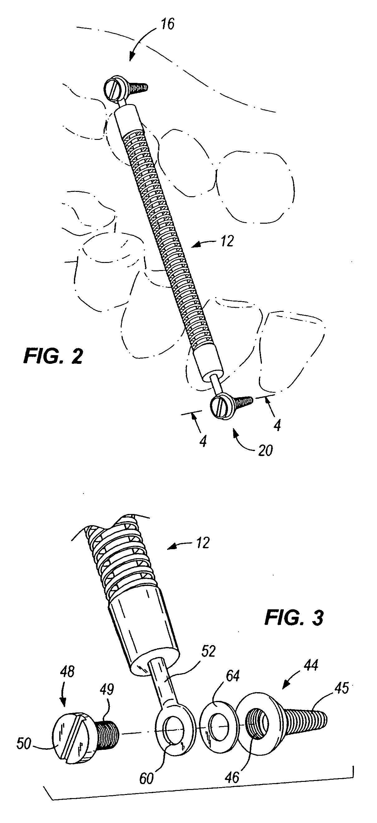 Orthopedic implant for mandibular advancer