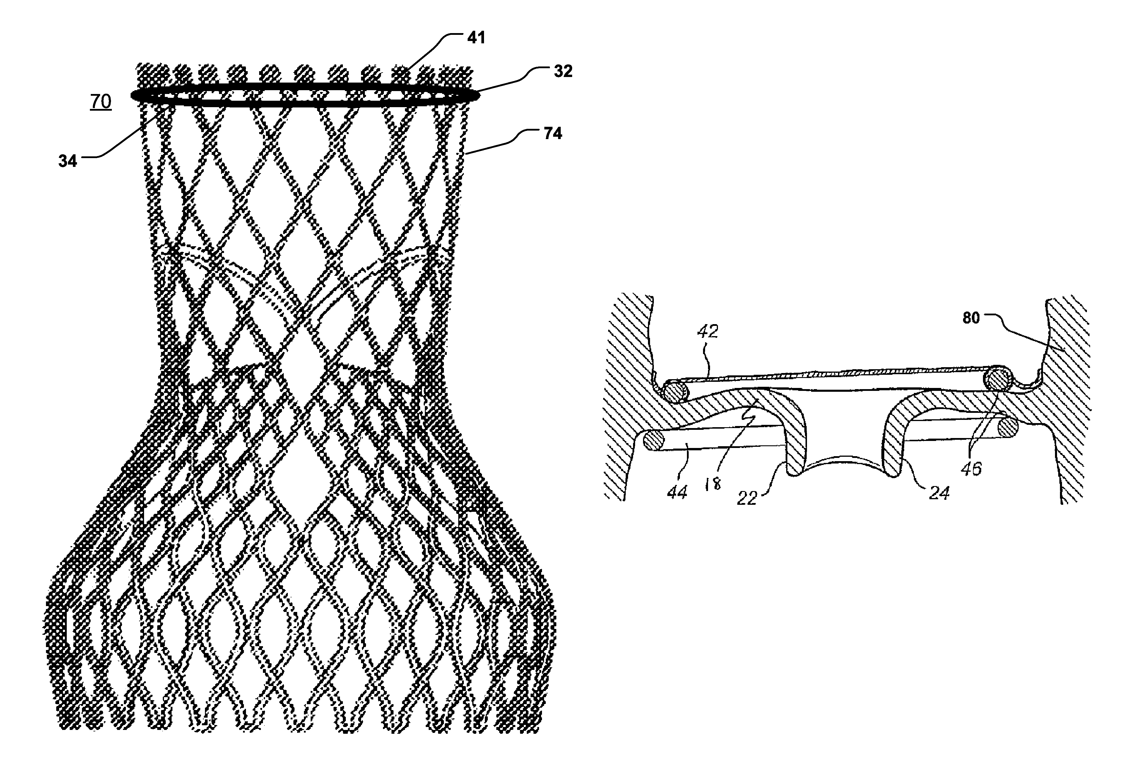 Arrangement, a loop-shaped support, a prosthetic heart valve and a method of repairing or replacing a native heart valve