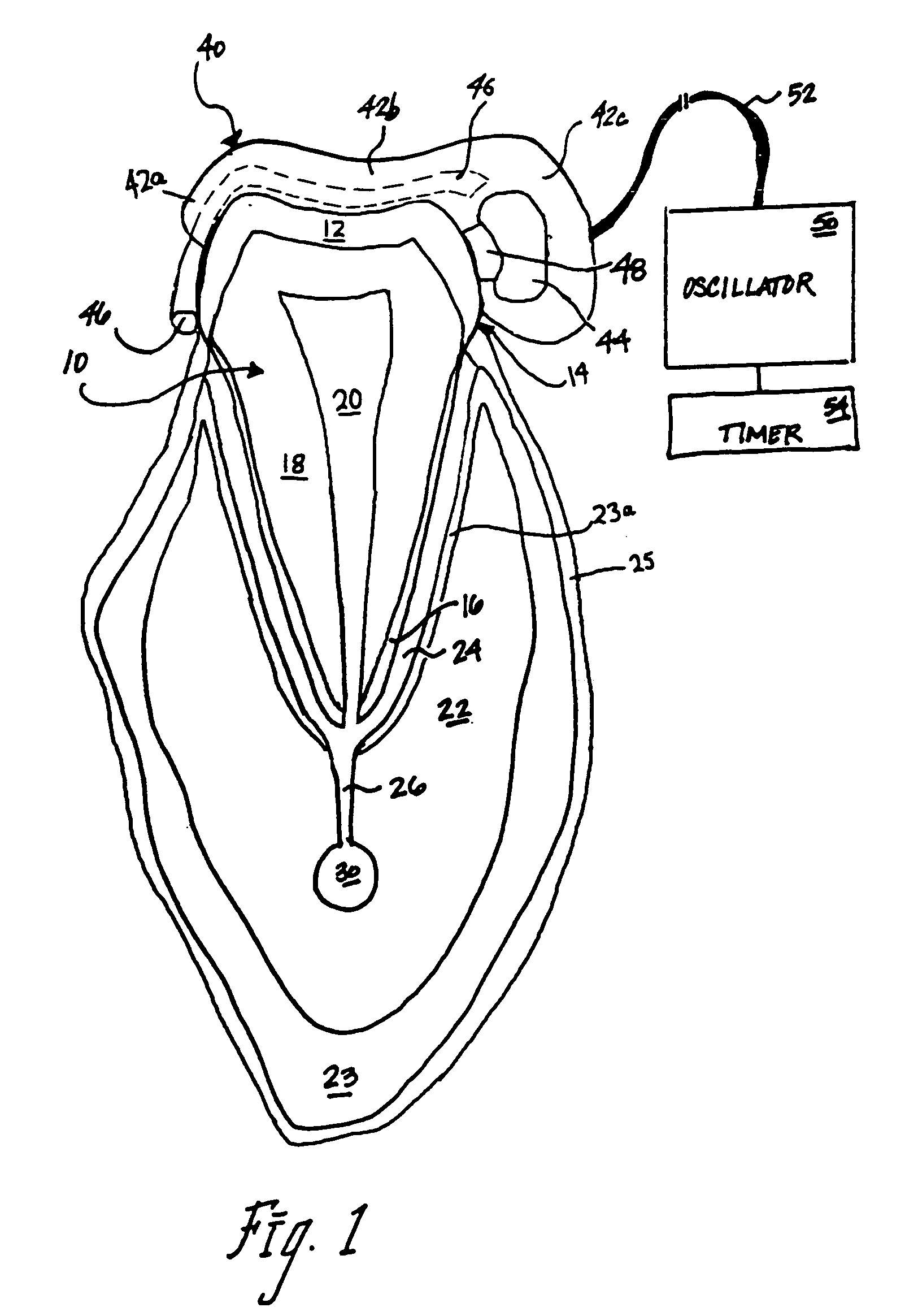 Apparatus and method for intra-oral stimulation of the trigeminal nerve