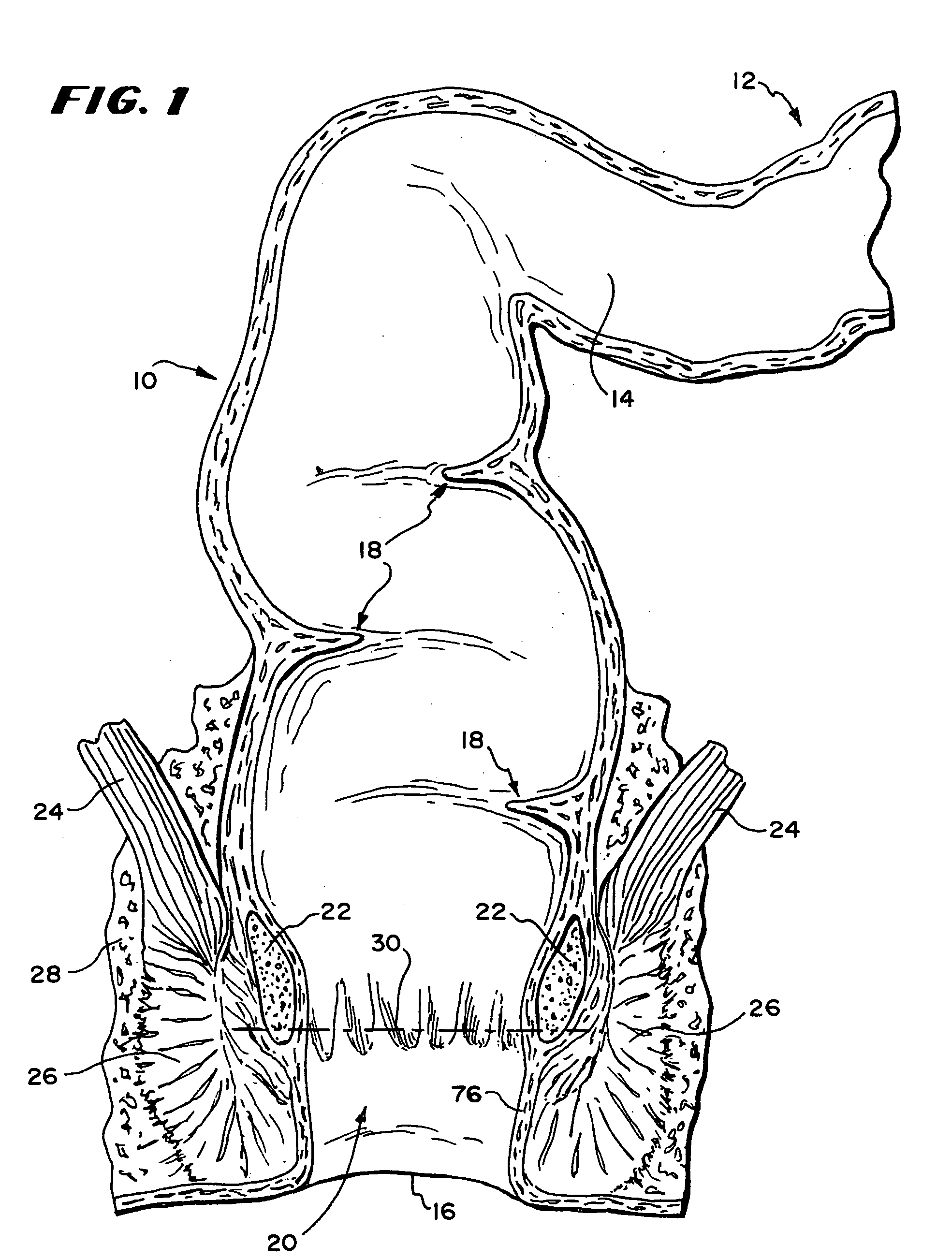 Method for treating fecal incontinence