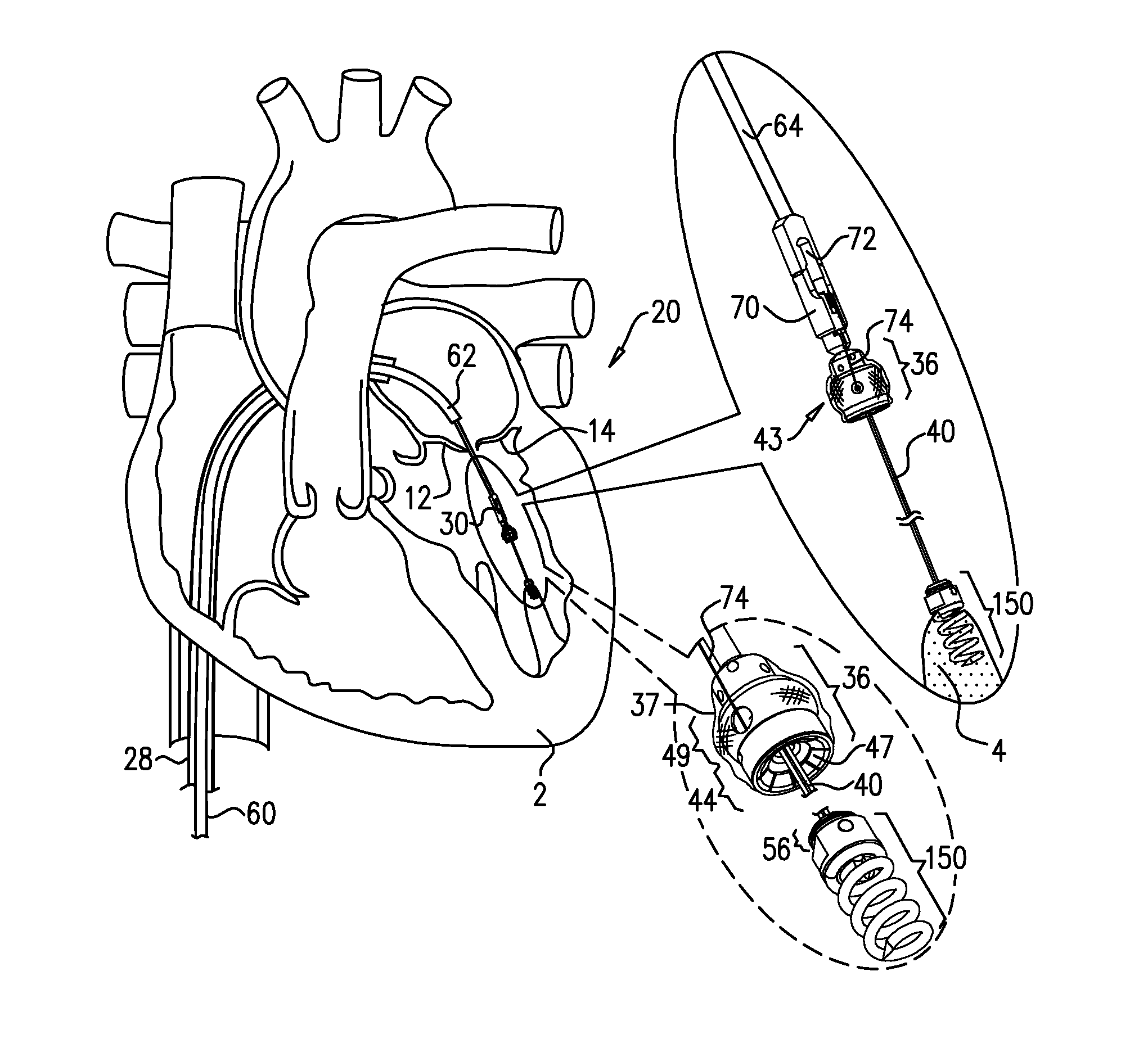 Apparatus for guide-wire based advancement of a rotation assembly