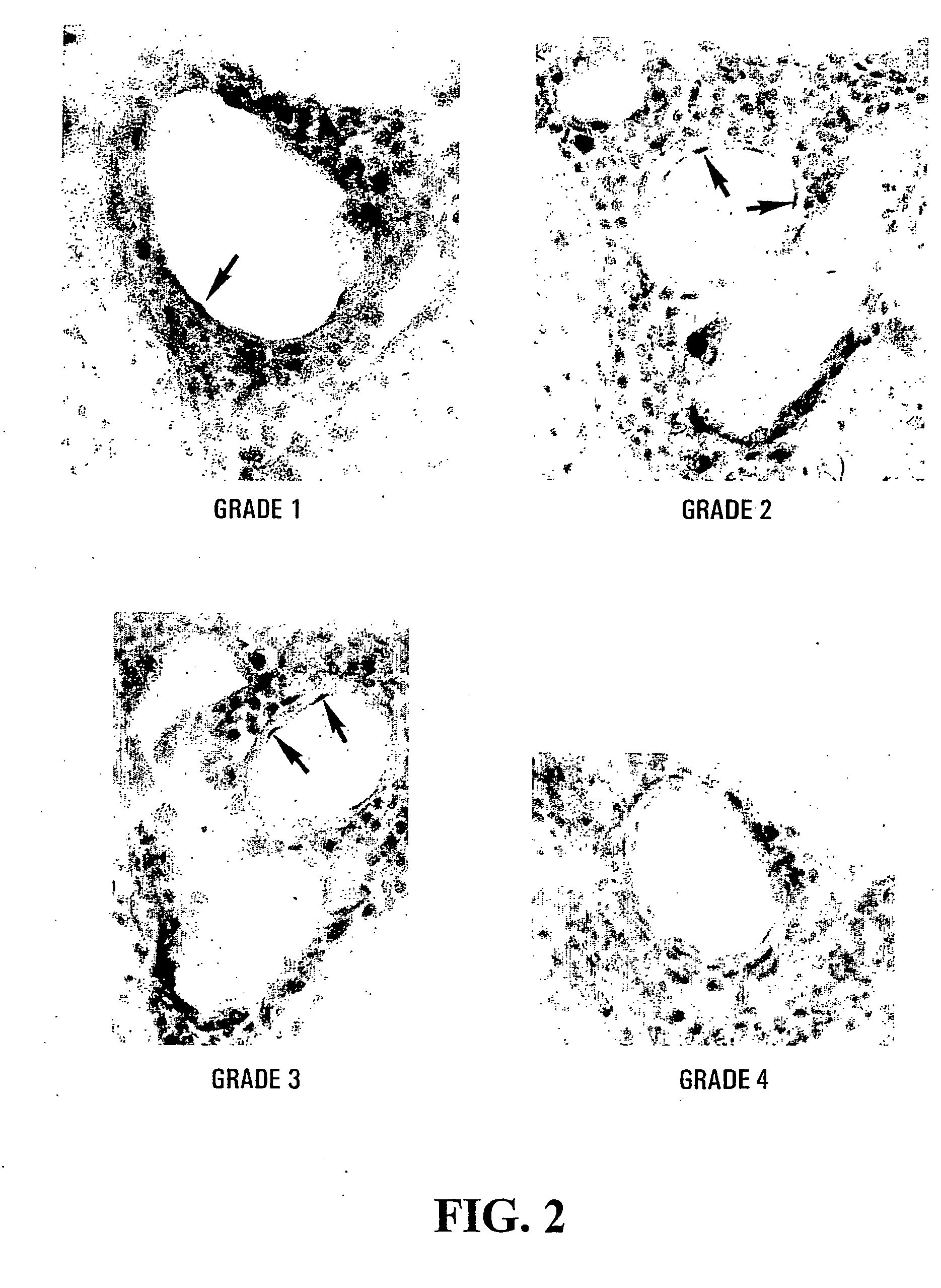 Used of inhibitors of phospholipase a2 for the treatment, prevention or diagnosis of neural inflammatory or demyelinating disease