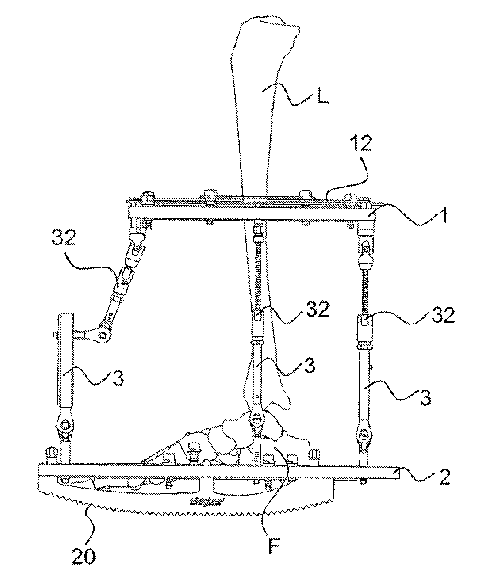 External fixator system