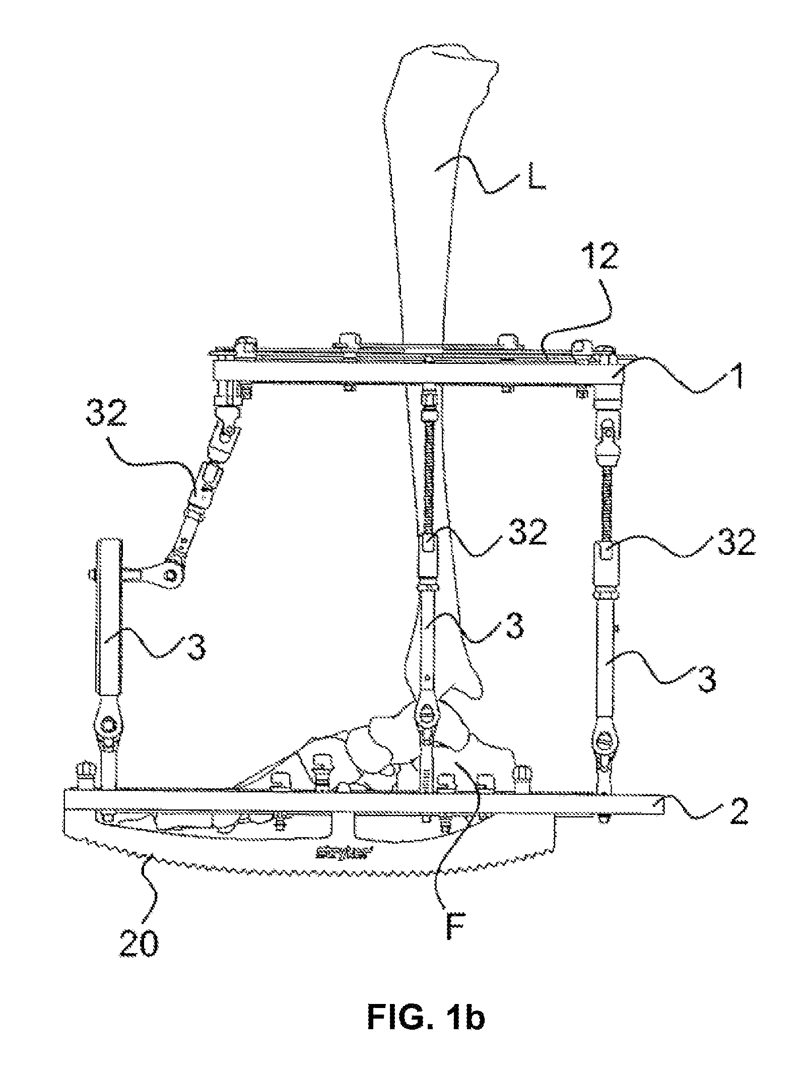 External fixator system