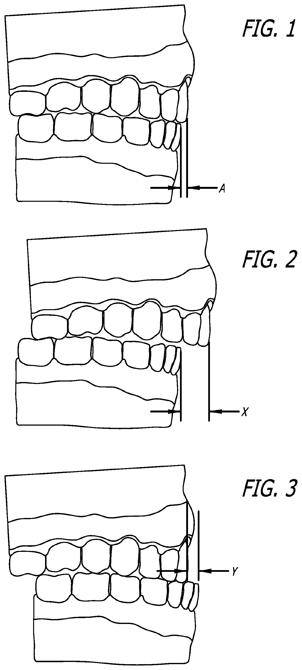 Orthodontic appliance and method of use