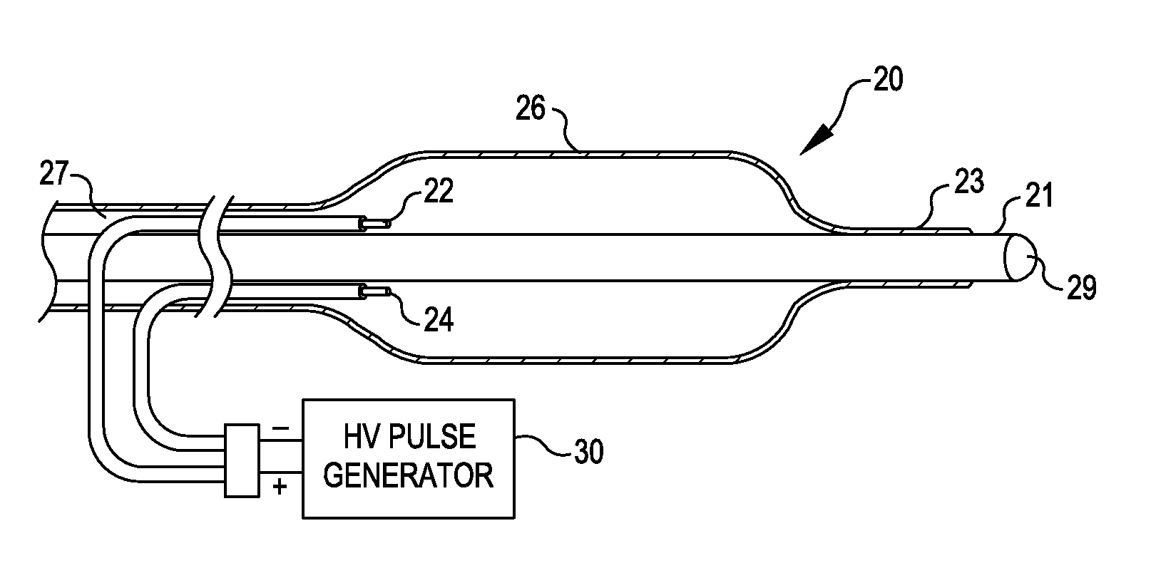 Shockwave balloon catheter system