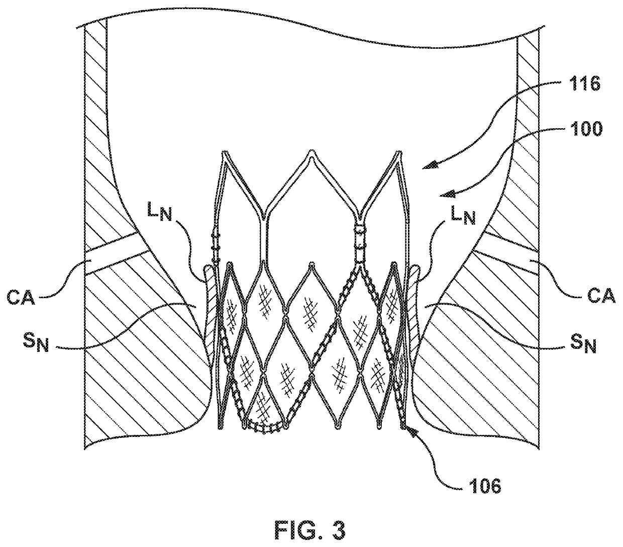 Balloon expandable frame for transcatheter implantation of a cardiac valve prosthesis