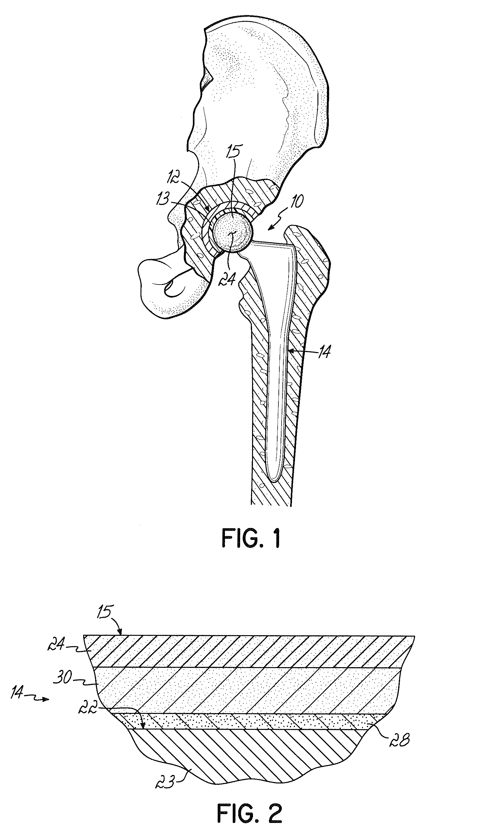 Titanium alloy with oxidized zirconium for a prosthetic implant