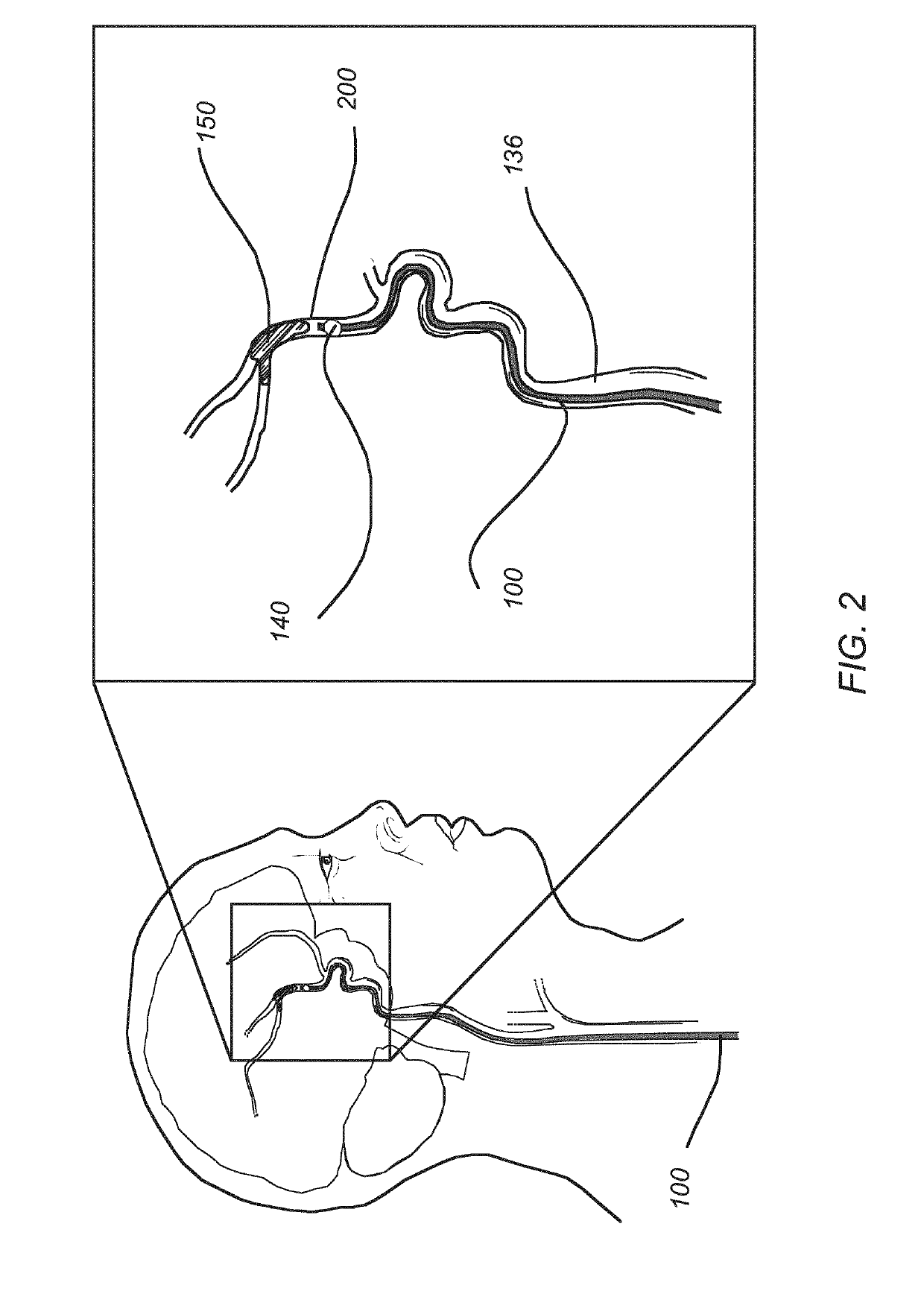 Post-conditioning suction catheter apparatus and methods