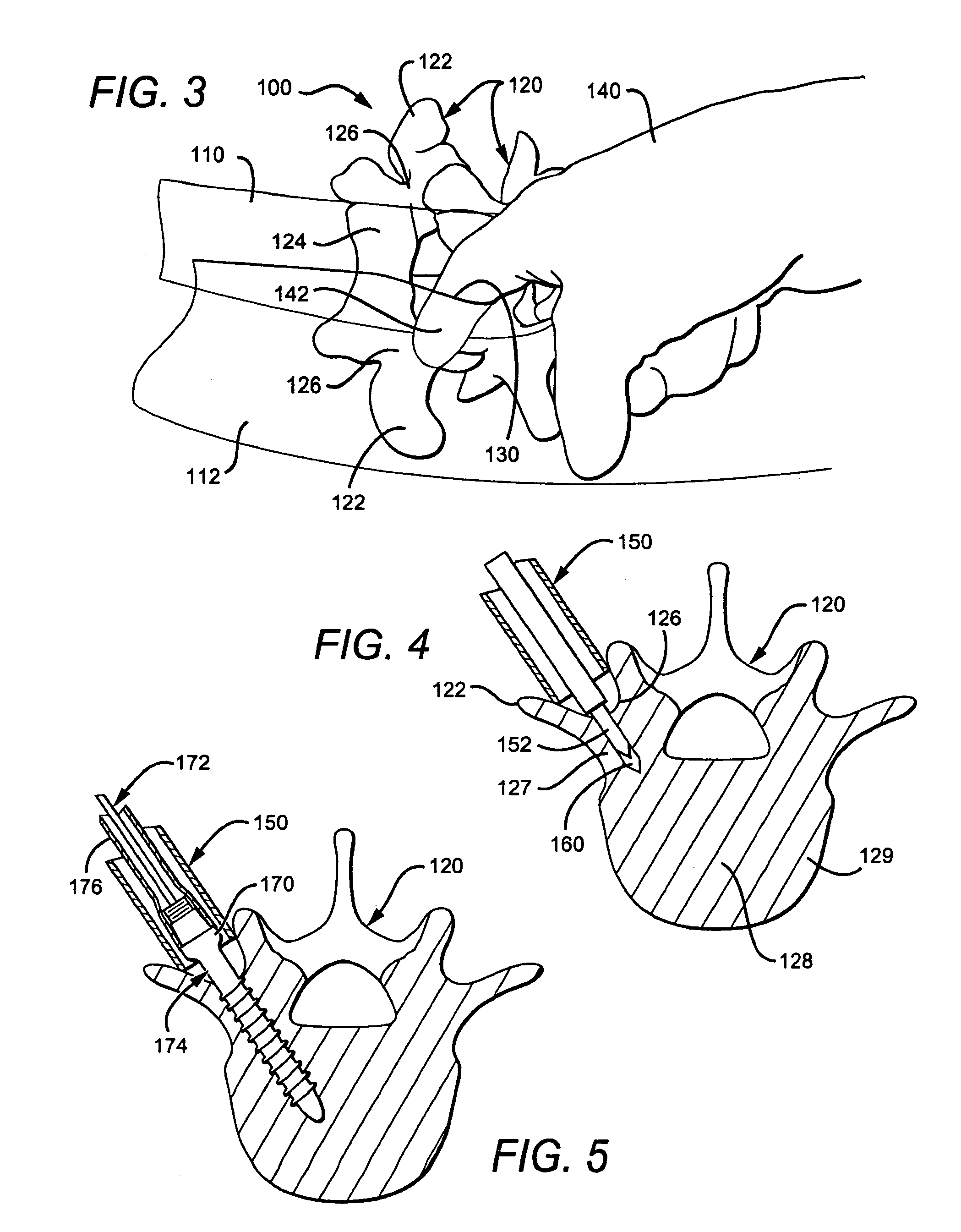 Guided retractor and methods of use