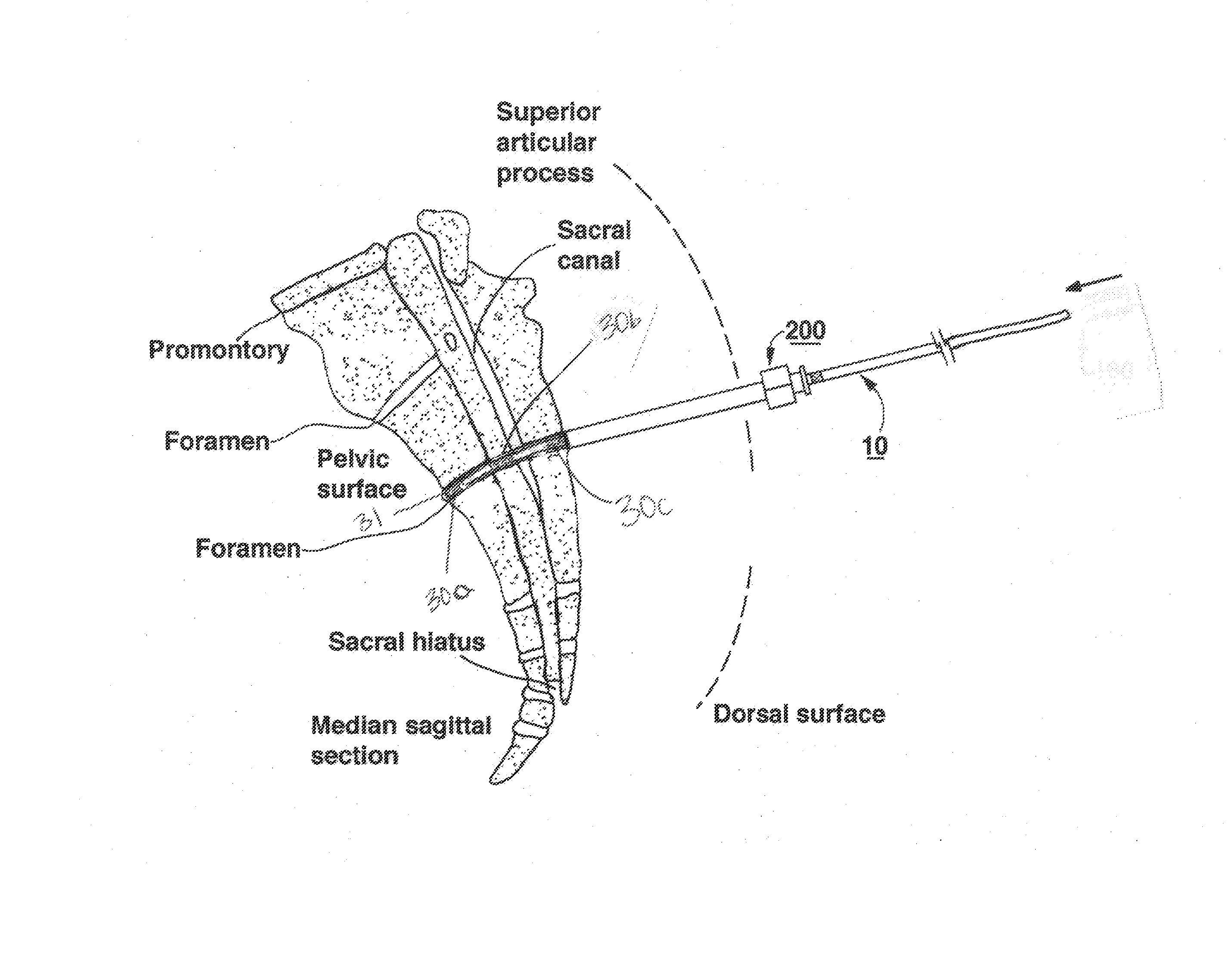 Implantable Medical Electrical Stimulation Lead Fixation Method and Apparatus