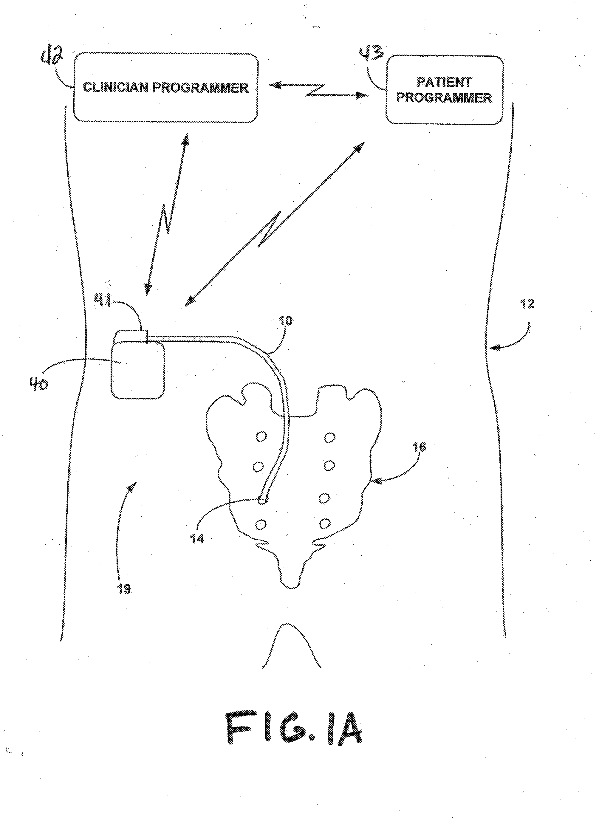 Implantable Medical Electrical Stimulation Lead Fixation Method and Apparatus