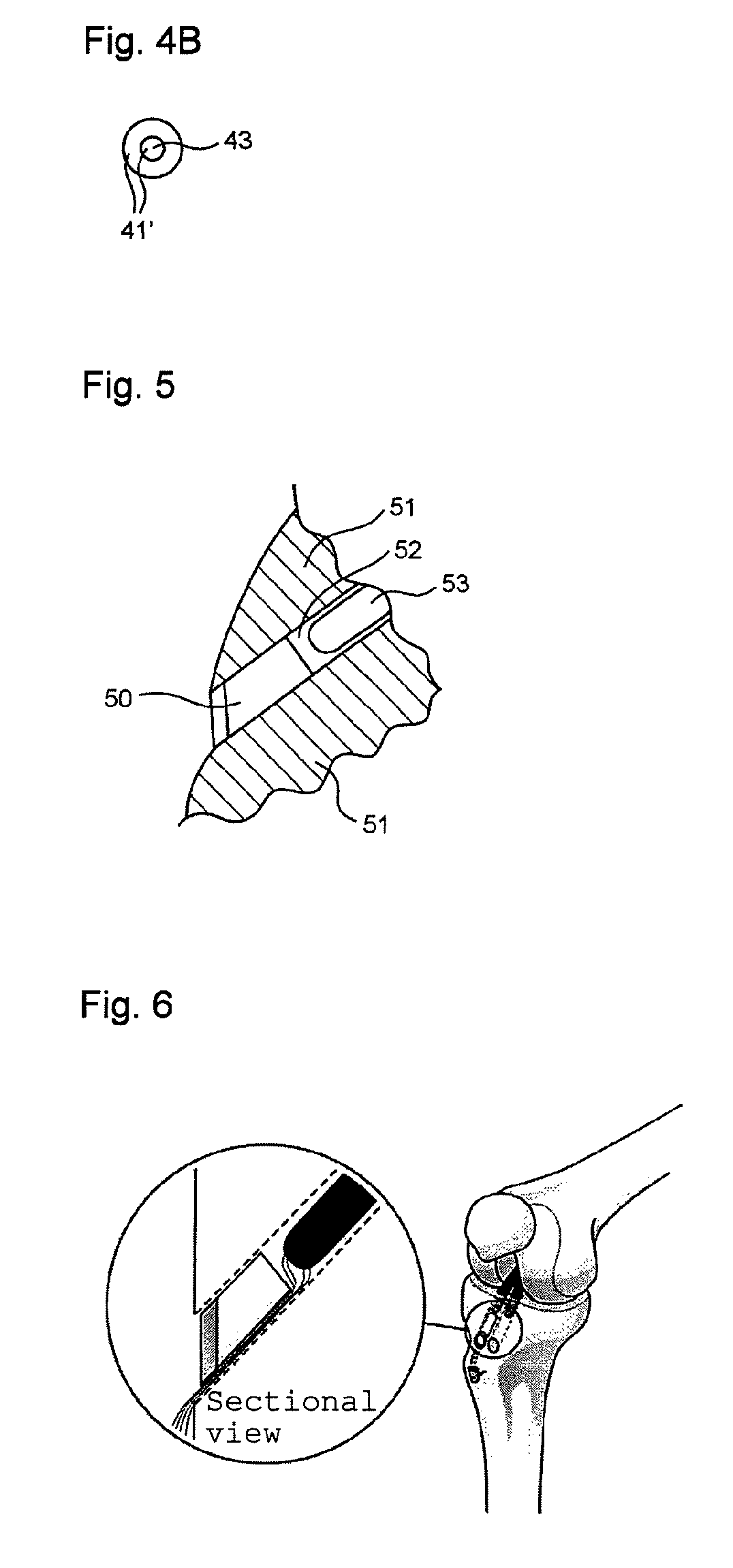 Plug components for bone tunnel