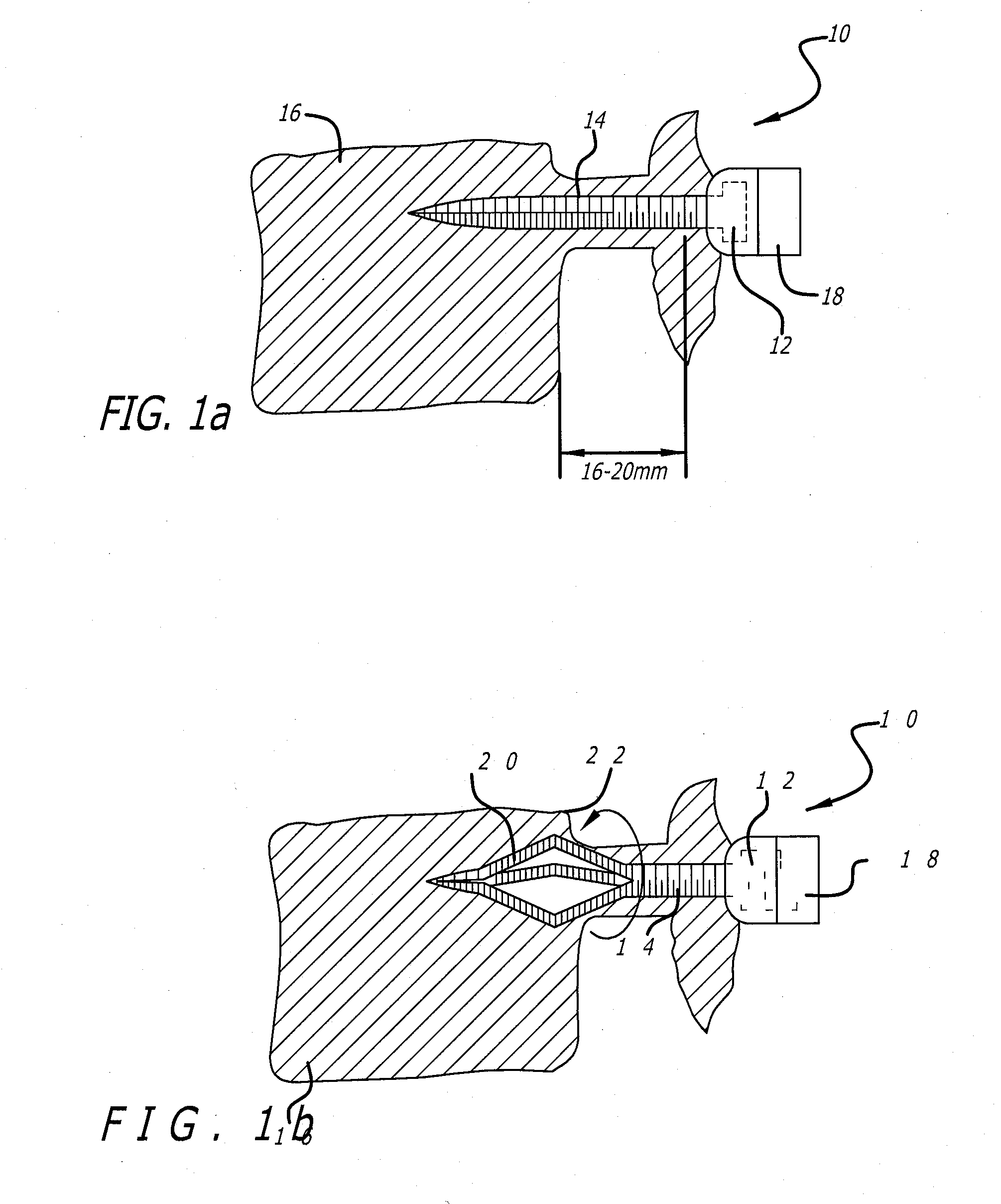 Reversibly expandable fixation device