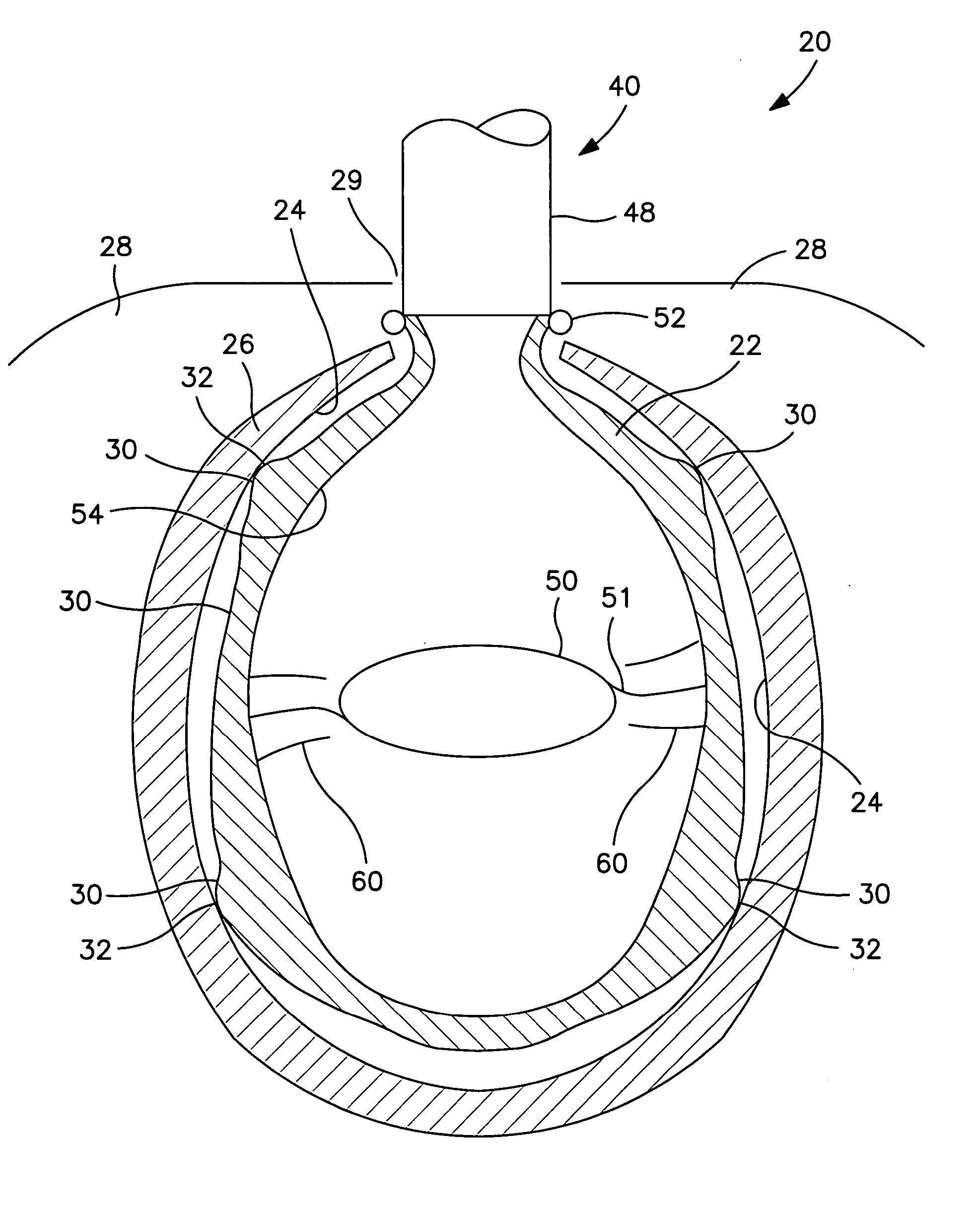 Interior bag for a capsular bag and injector