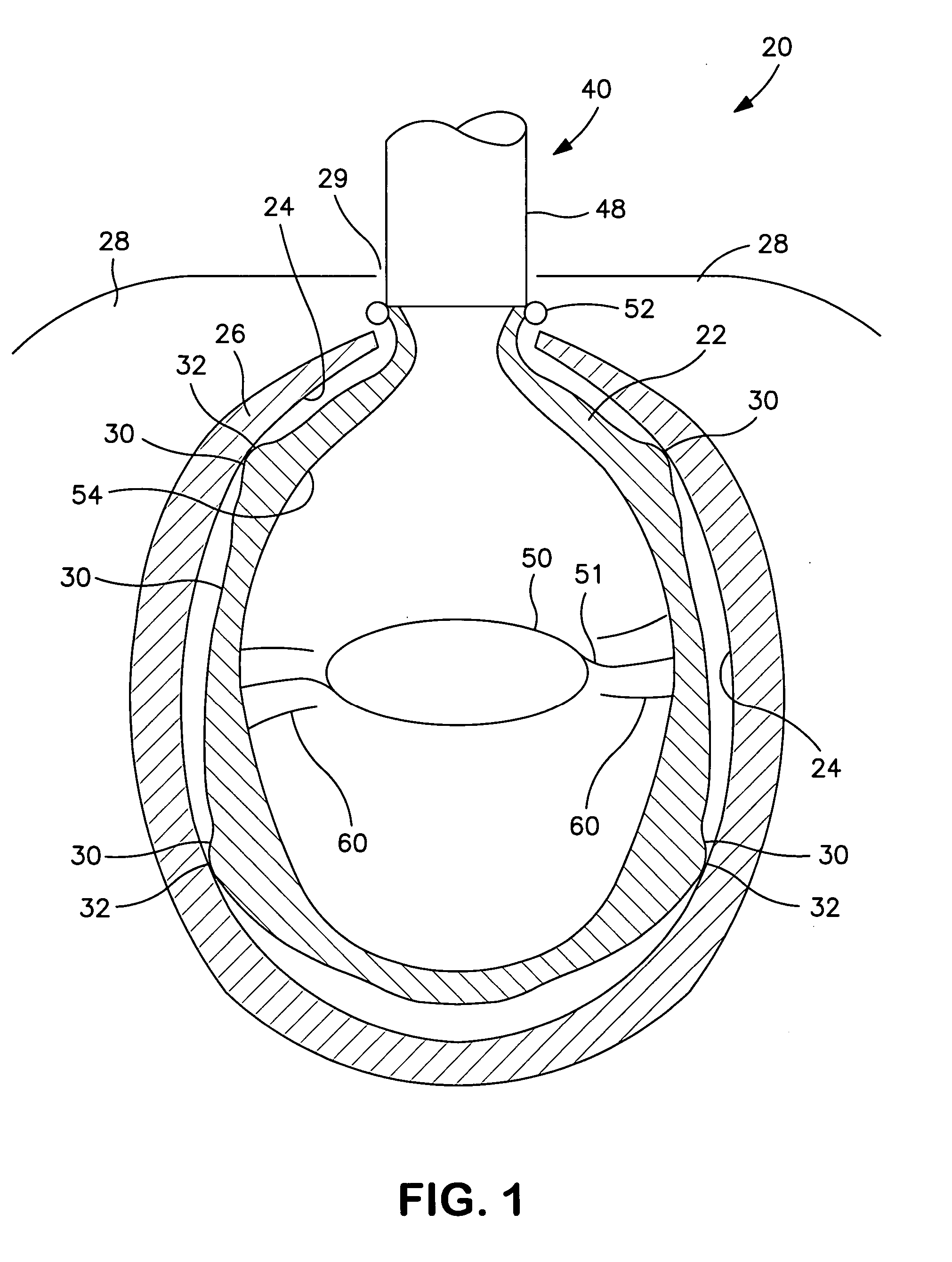 Interior bag for a capsular bag and injector