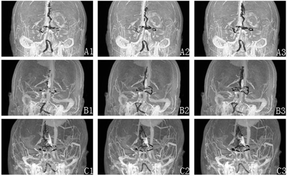 Automatic cerebral artery sketching method based on deep neural network