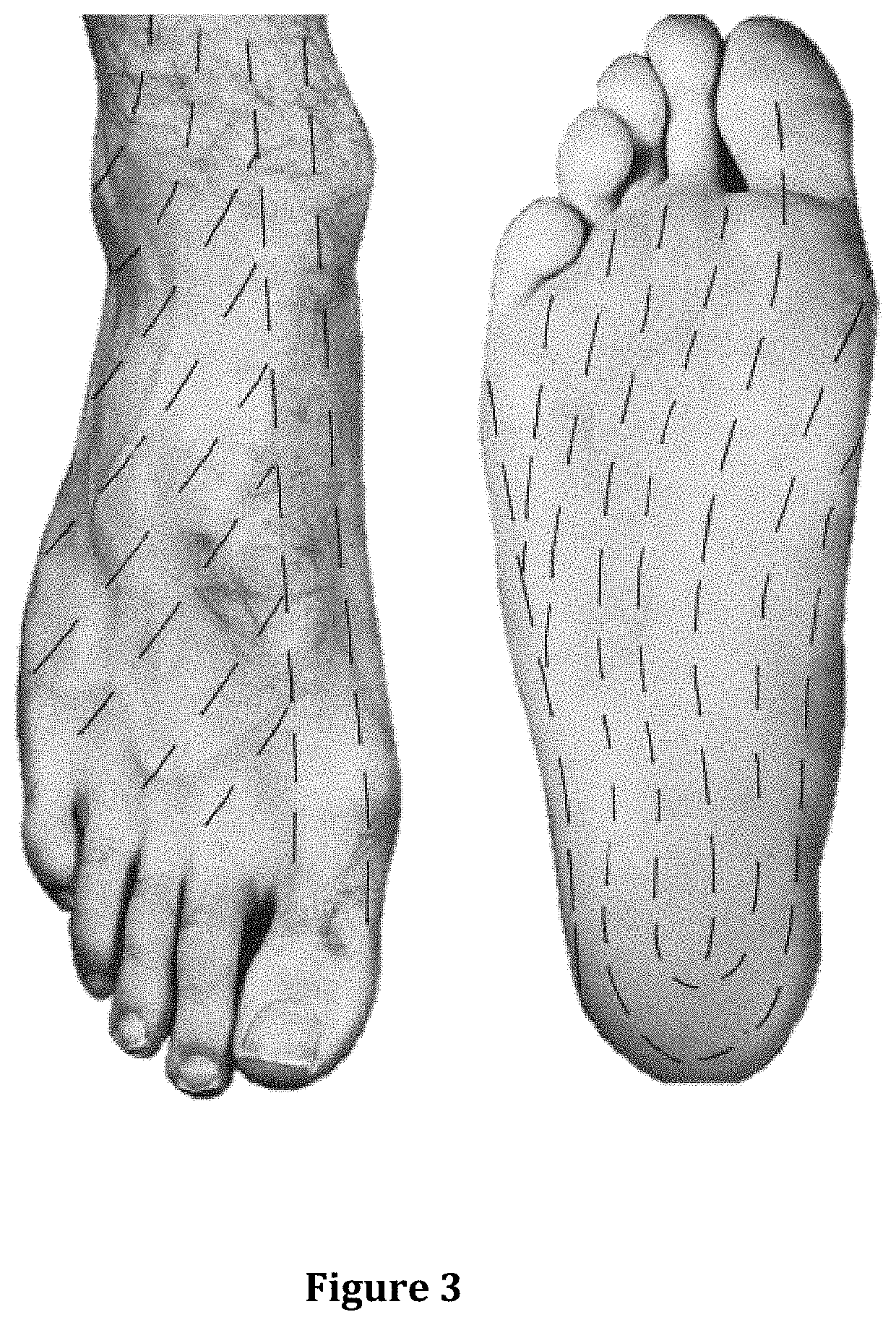 Apical surgical wound debridement