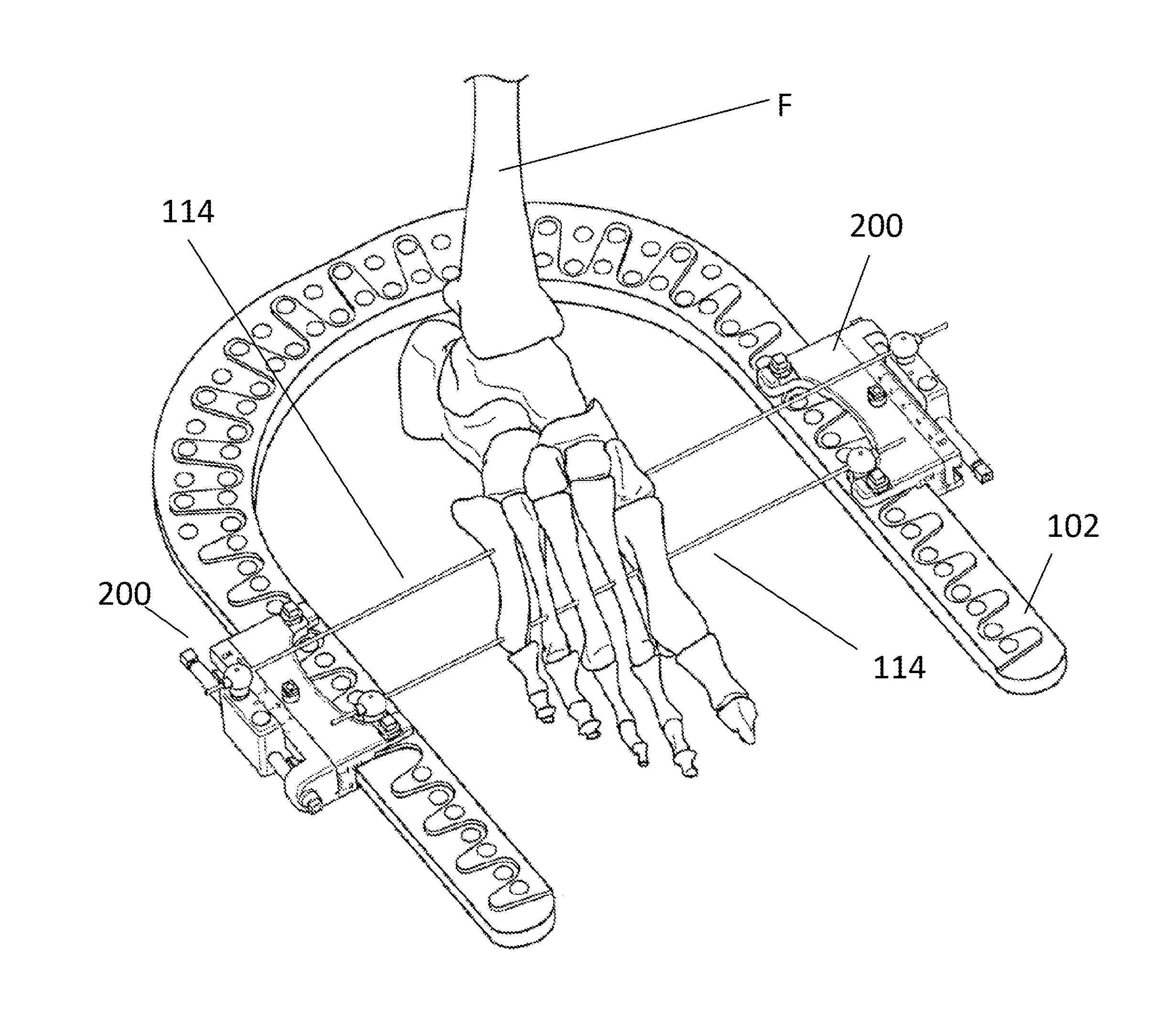 External fixator system