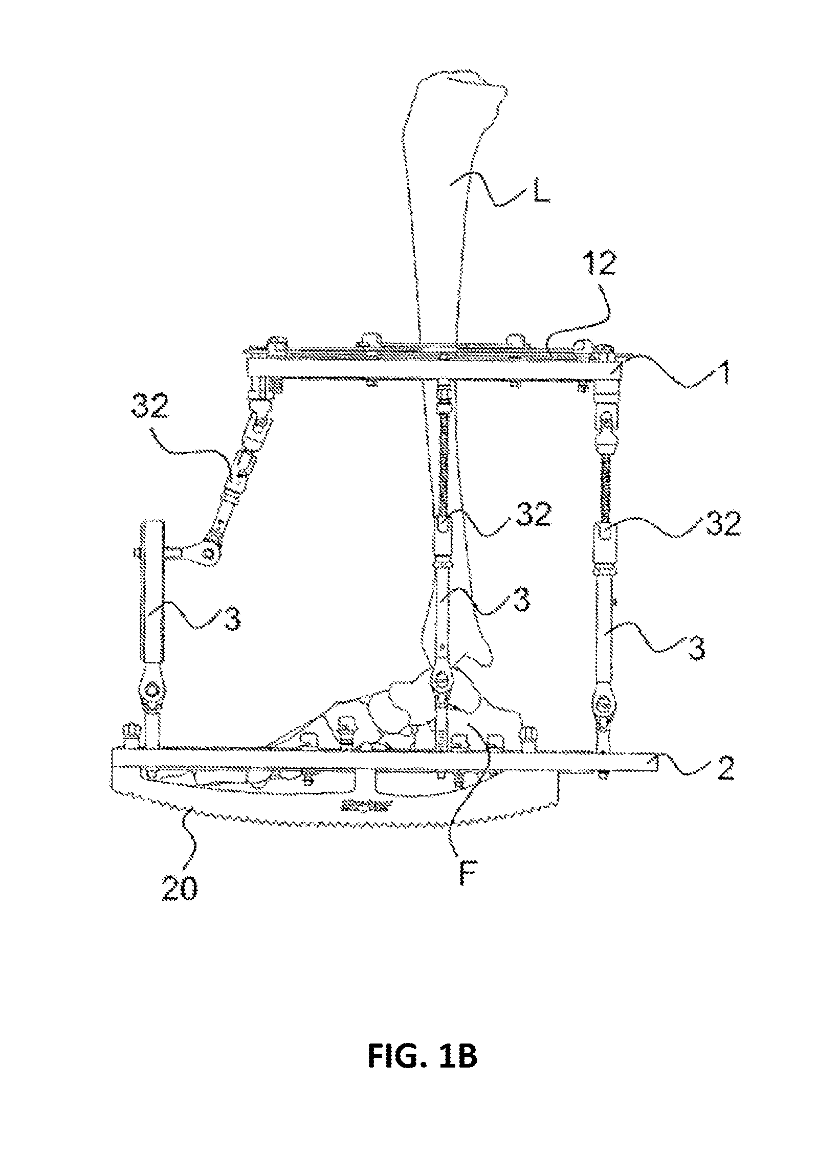 External fixator system