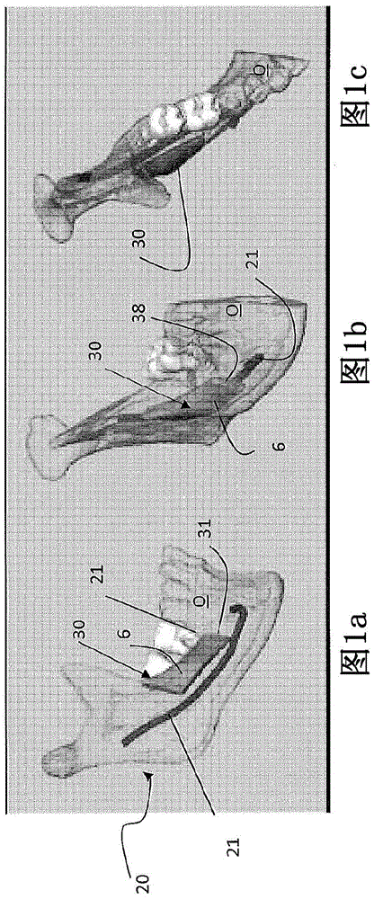 Method for making a surgical guide for bone harvesting