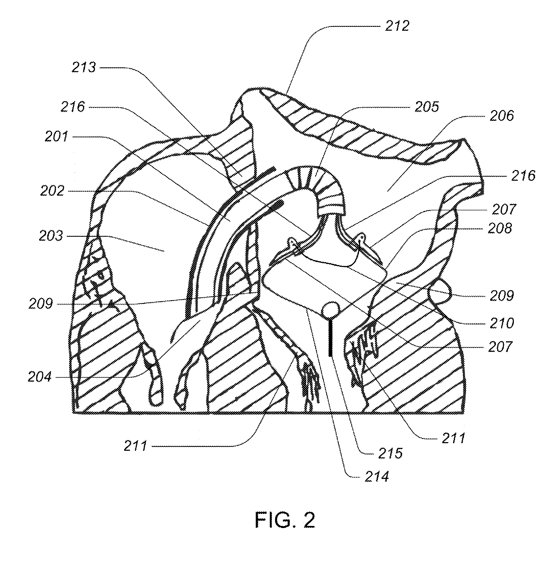 Medical kit for constricting tissue or a bodily orifice, for example, a mitral valve