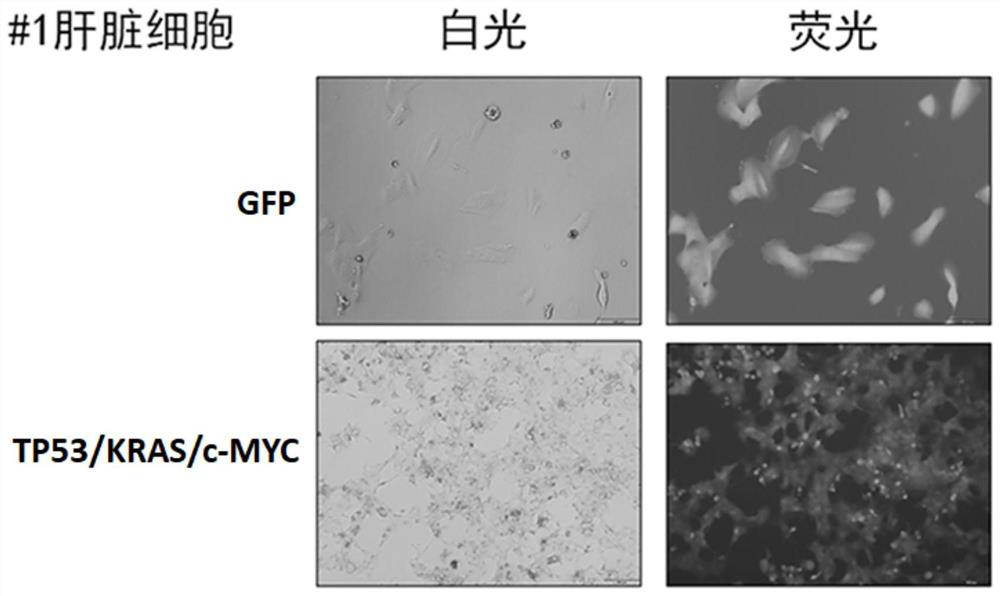 Gene combination for inducing hepatocytes into live cancer cells and application of gene combination