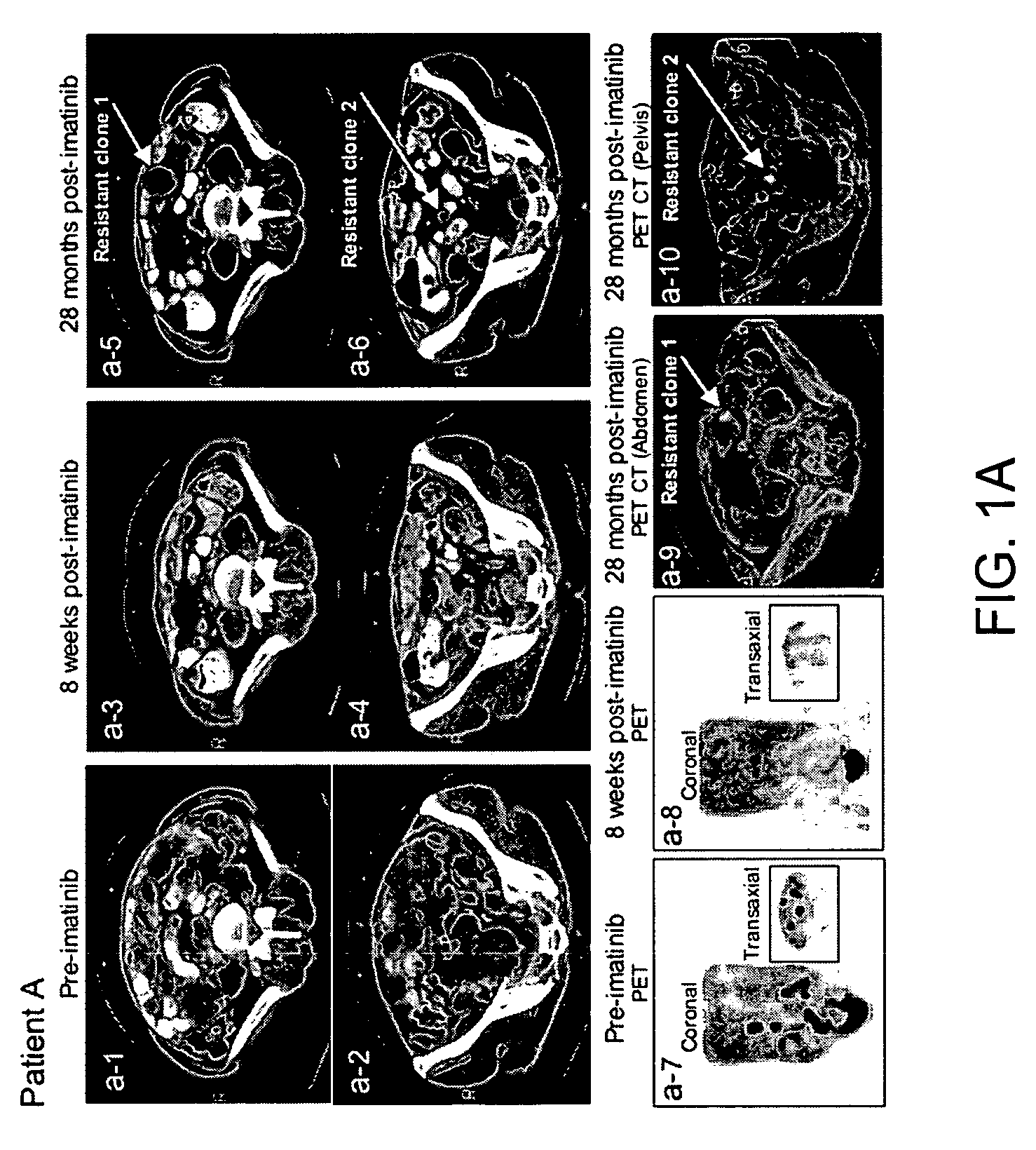 Mutations in KIT confer imatinib resistance in gastrointestinal stromal tumors