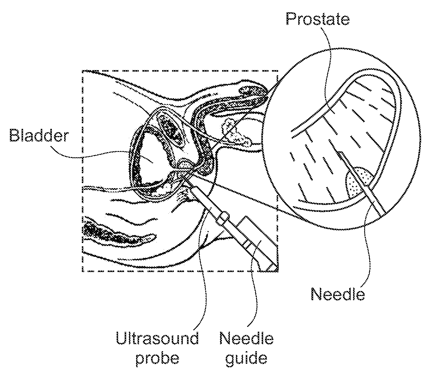 Biopsy device with acoustic element