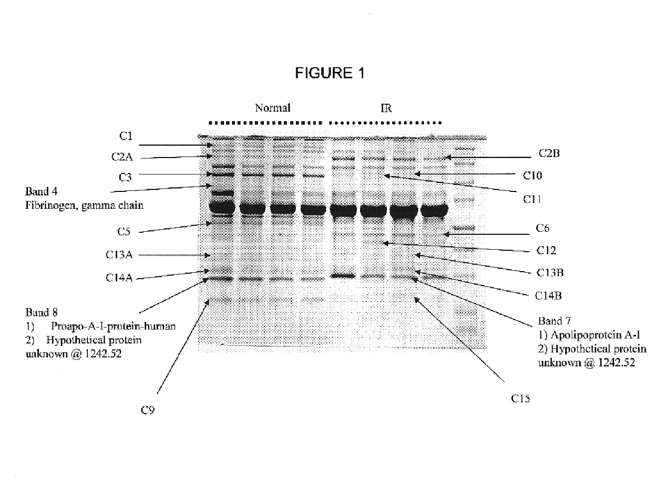 HP biopolymer markers predictive of insulin resistance