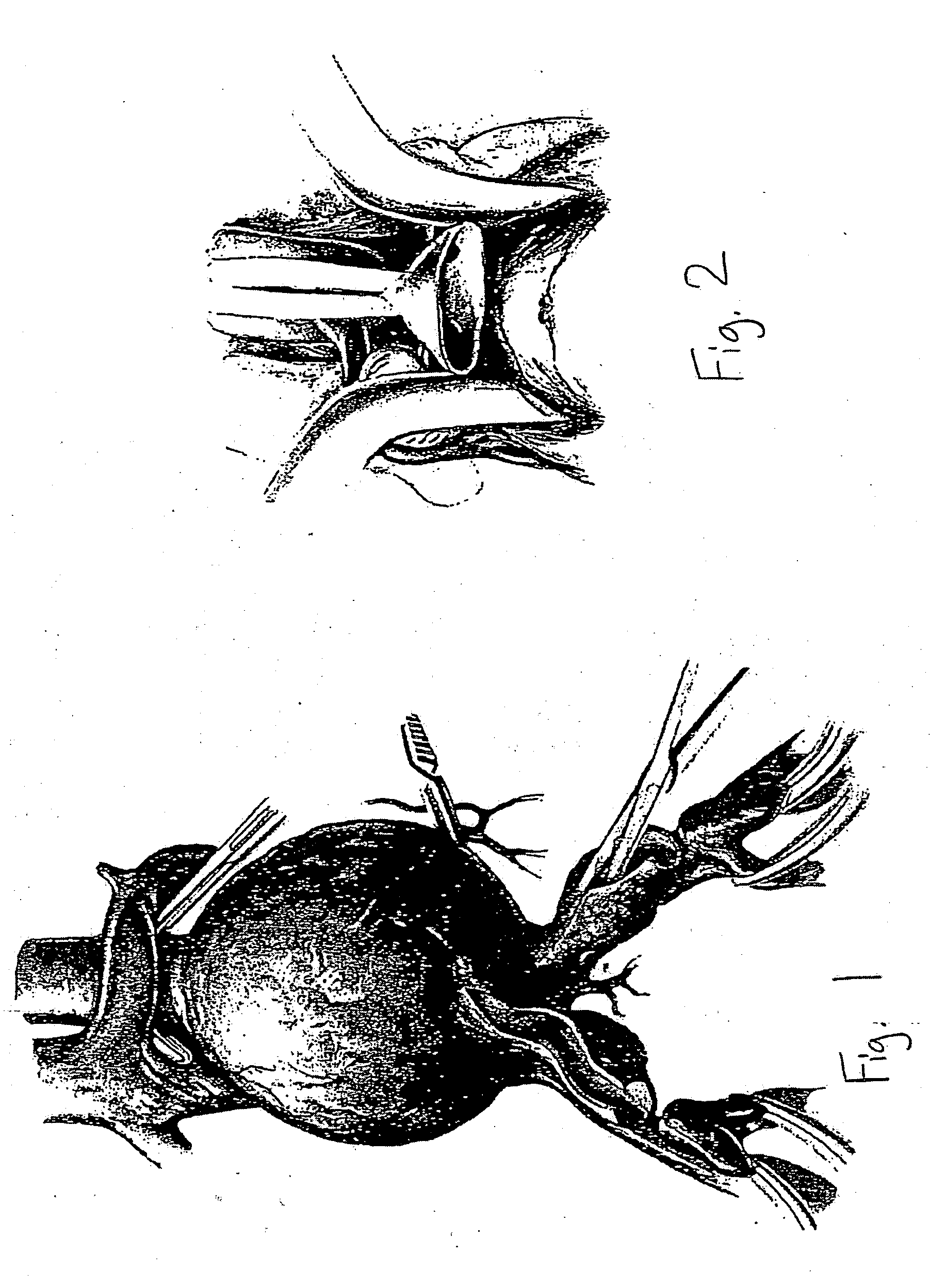 Blood vessel graft sizer