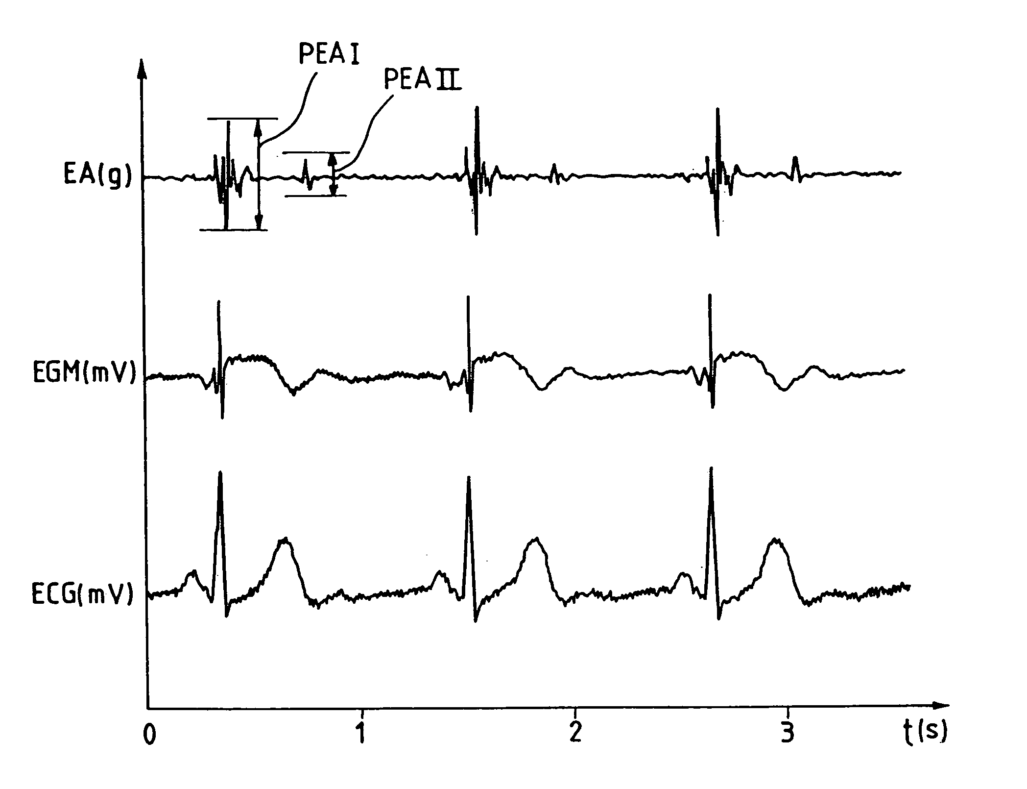 Monitoring the sympathico-vagal activity by analysis of endocardiac acceleration in an active implantable medical device