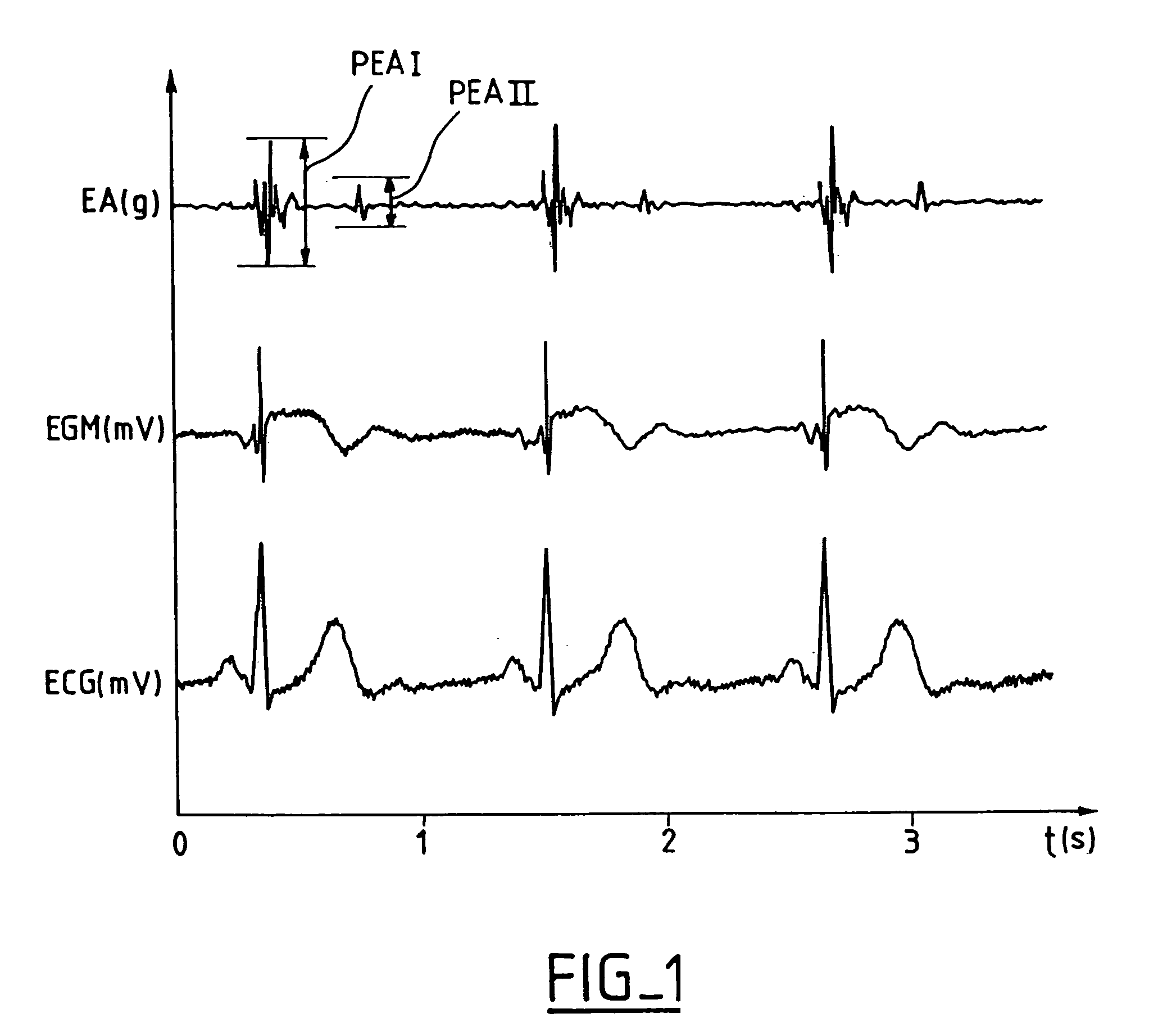 Monitoring the sympathico-vagal activity by analysis of endocardiac acceleration in an active implantable medical device