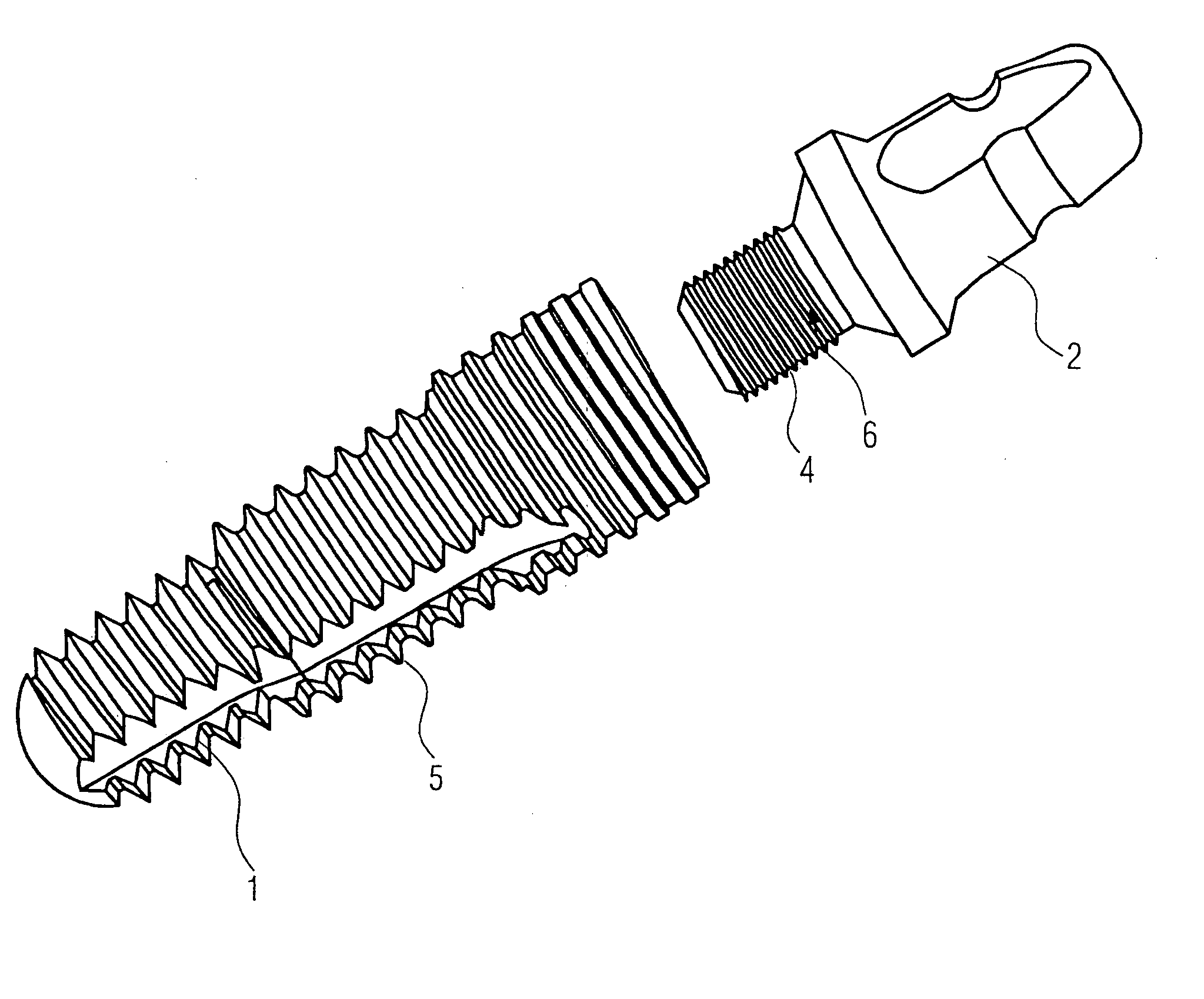 Dental implant