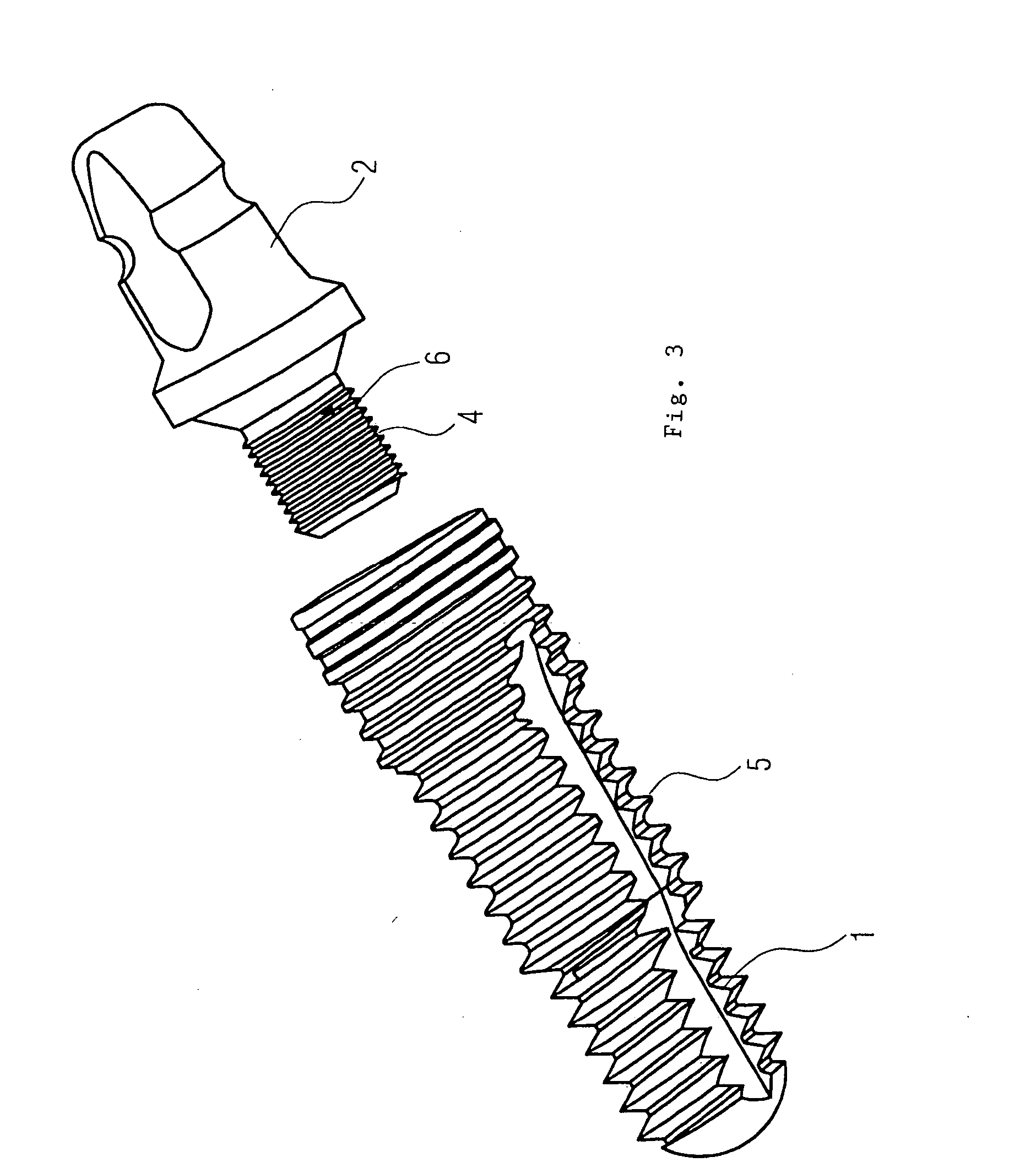 Dental implant