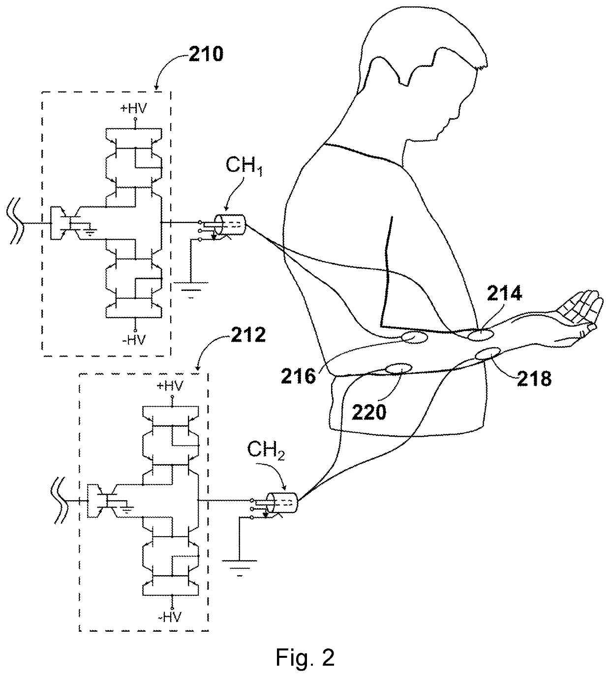 Neuromuscular stimulation using multistage current driver circuit