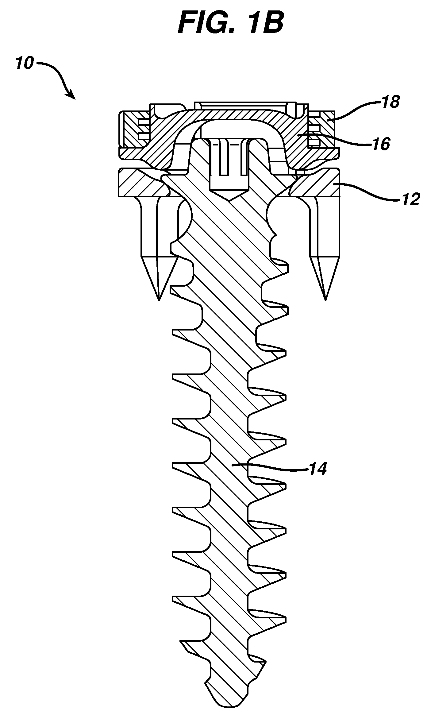 Low profile spinal tethering methods