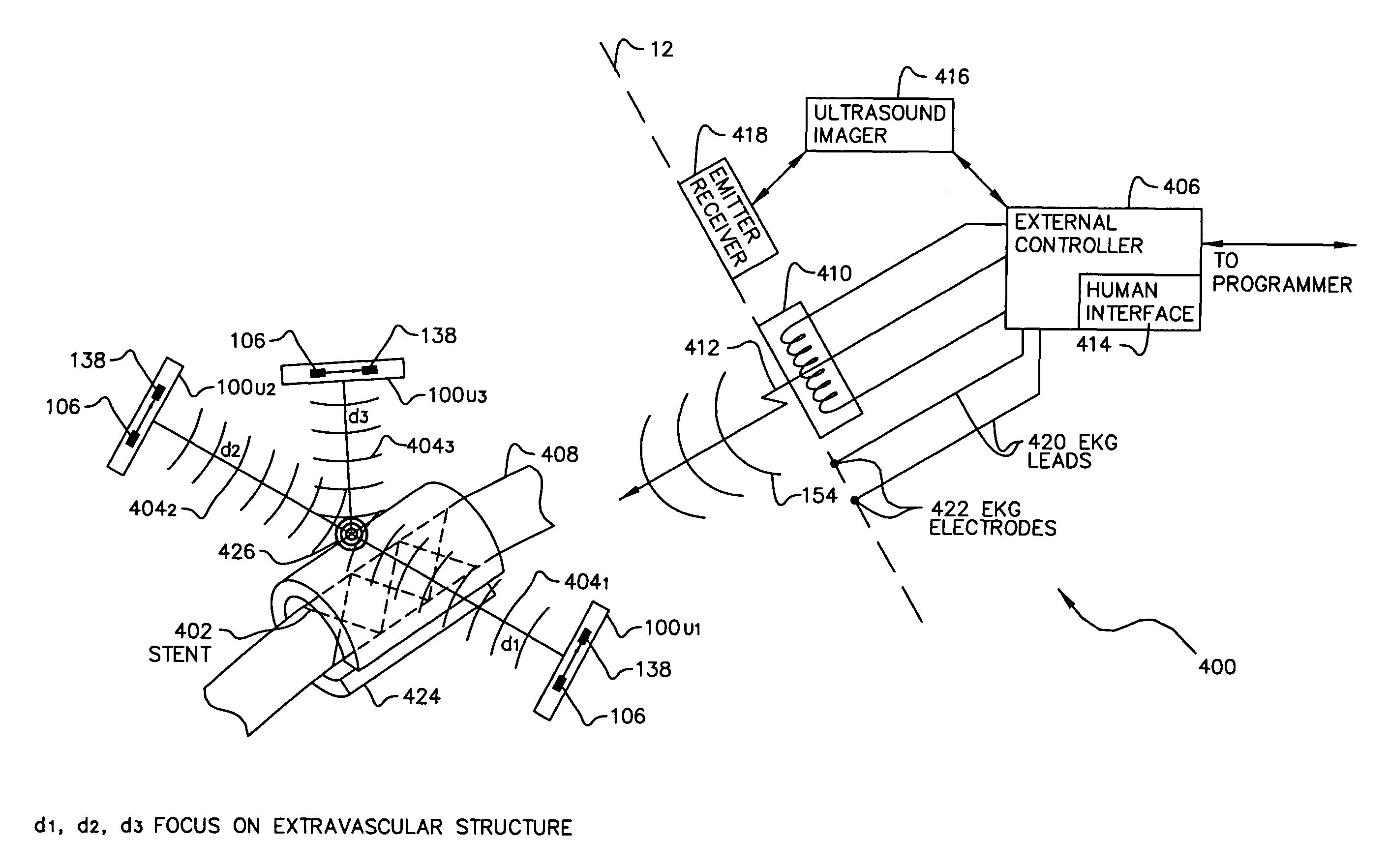 System of implantable ultrasonic emitters for preventing restenosis following a stent procedure