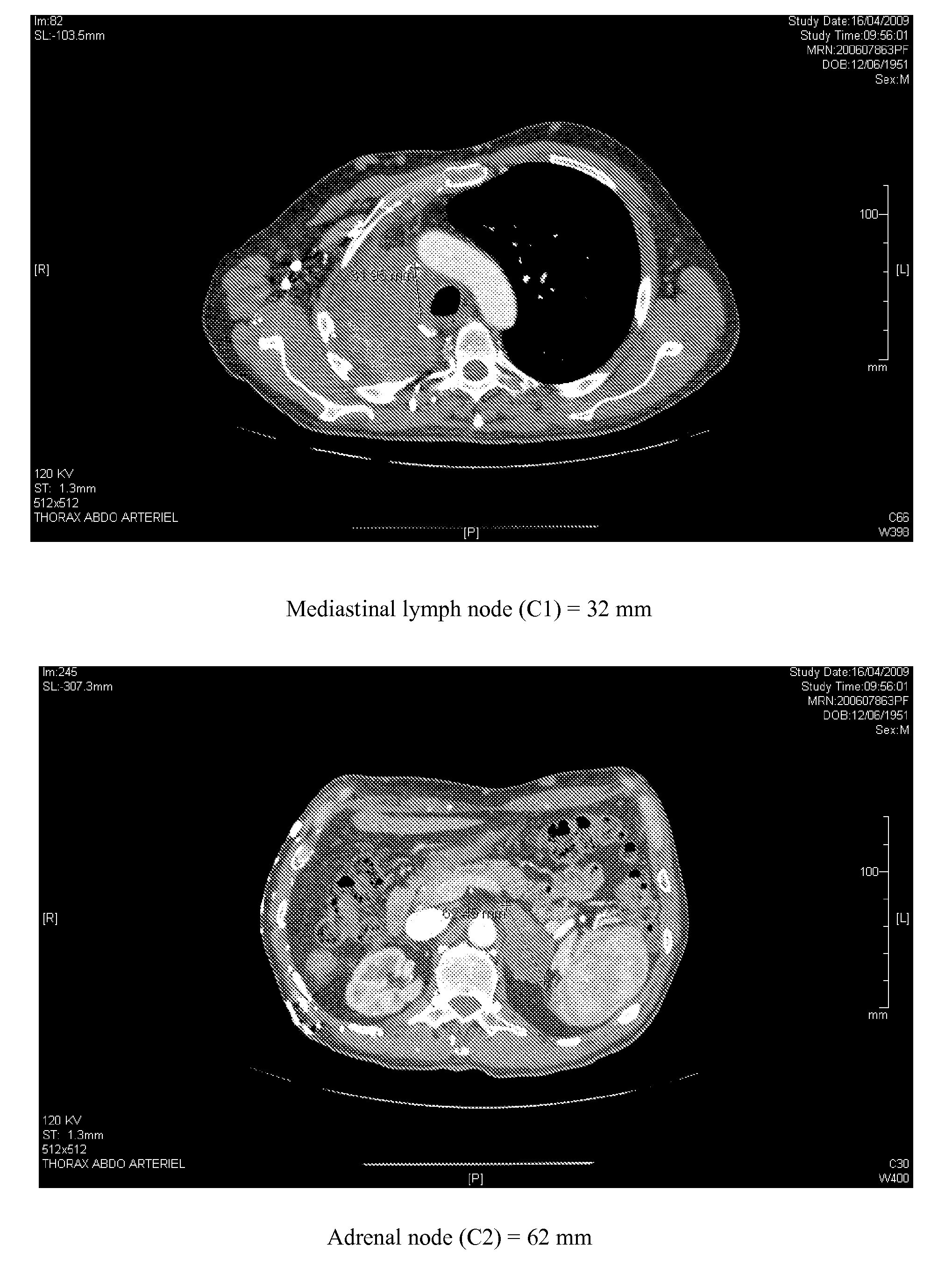 Method for predicting efficacy of drugs in a patient