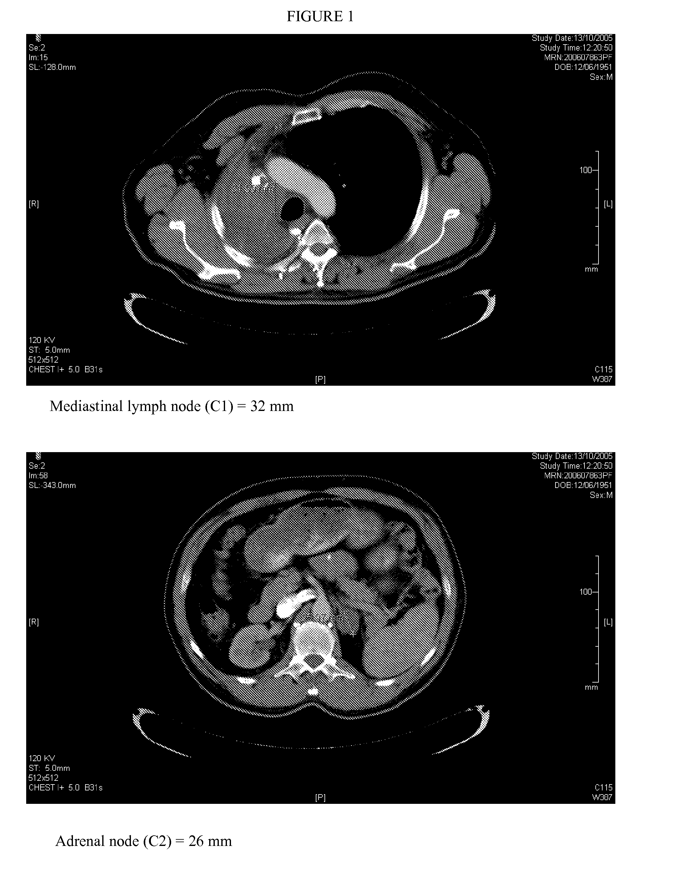 Method for predicting efficacy of drugs in a patient