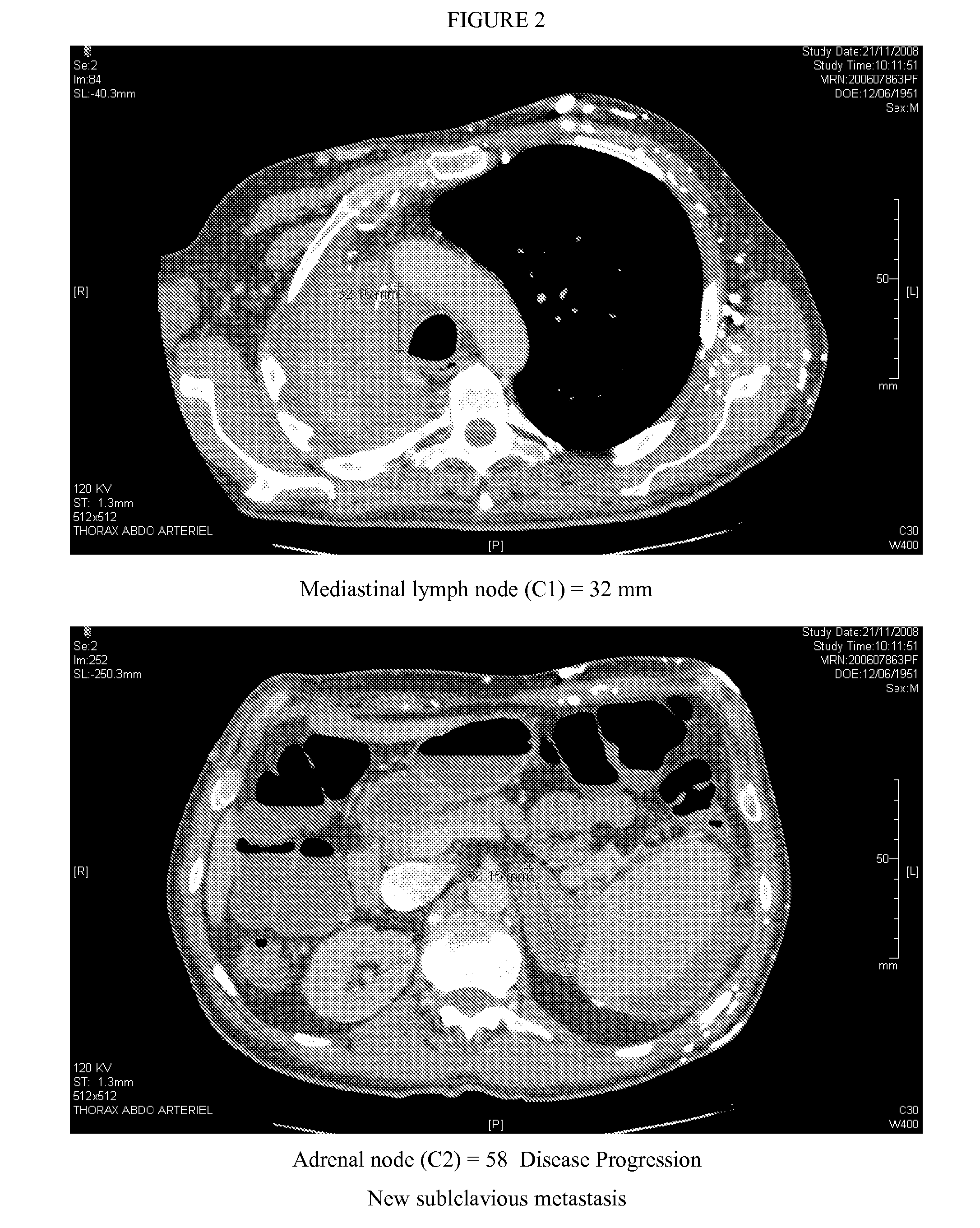 Method for predicting efficacy of drugs in a patient