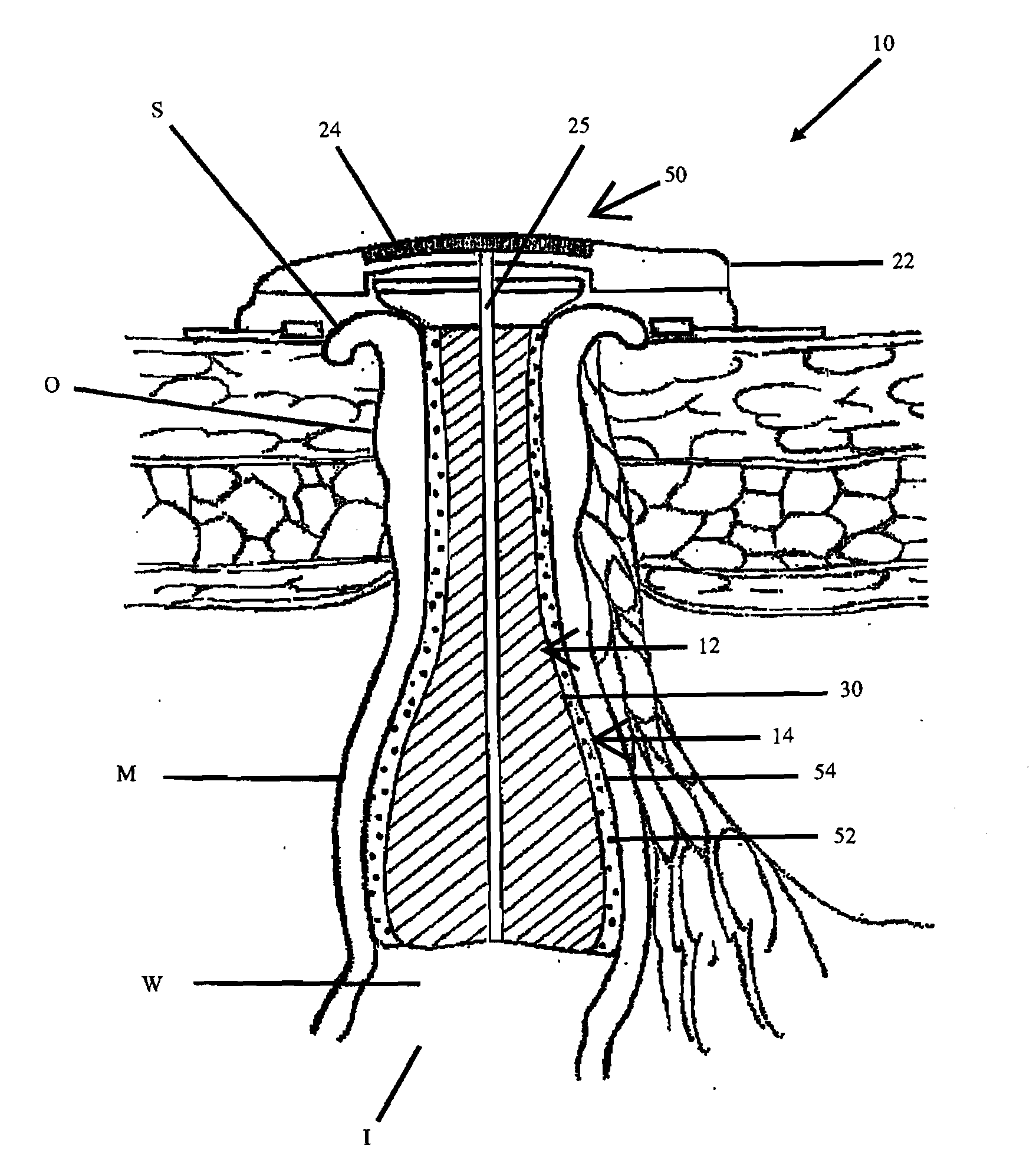 Continent ostomy system with chemical neuromuscular control