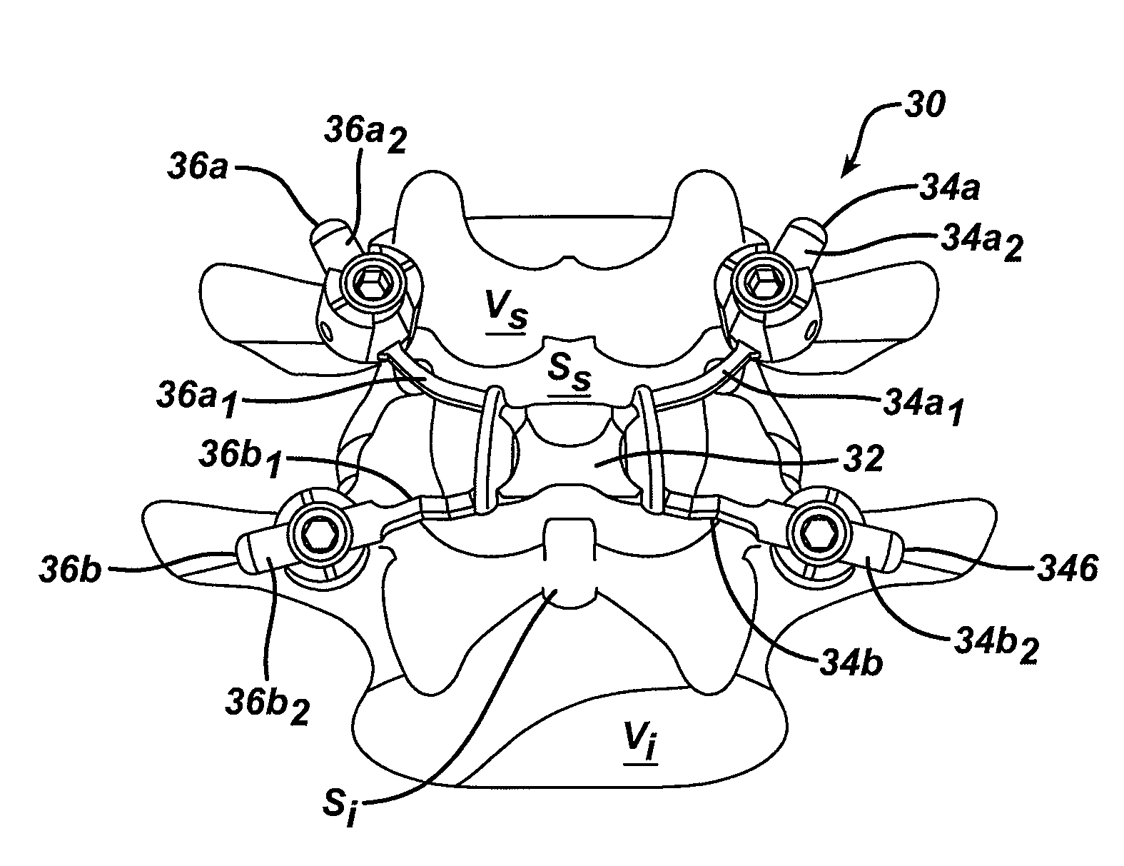 Posterior dynamic stabilization x-device