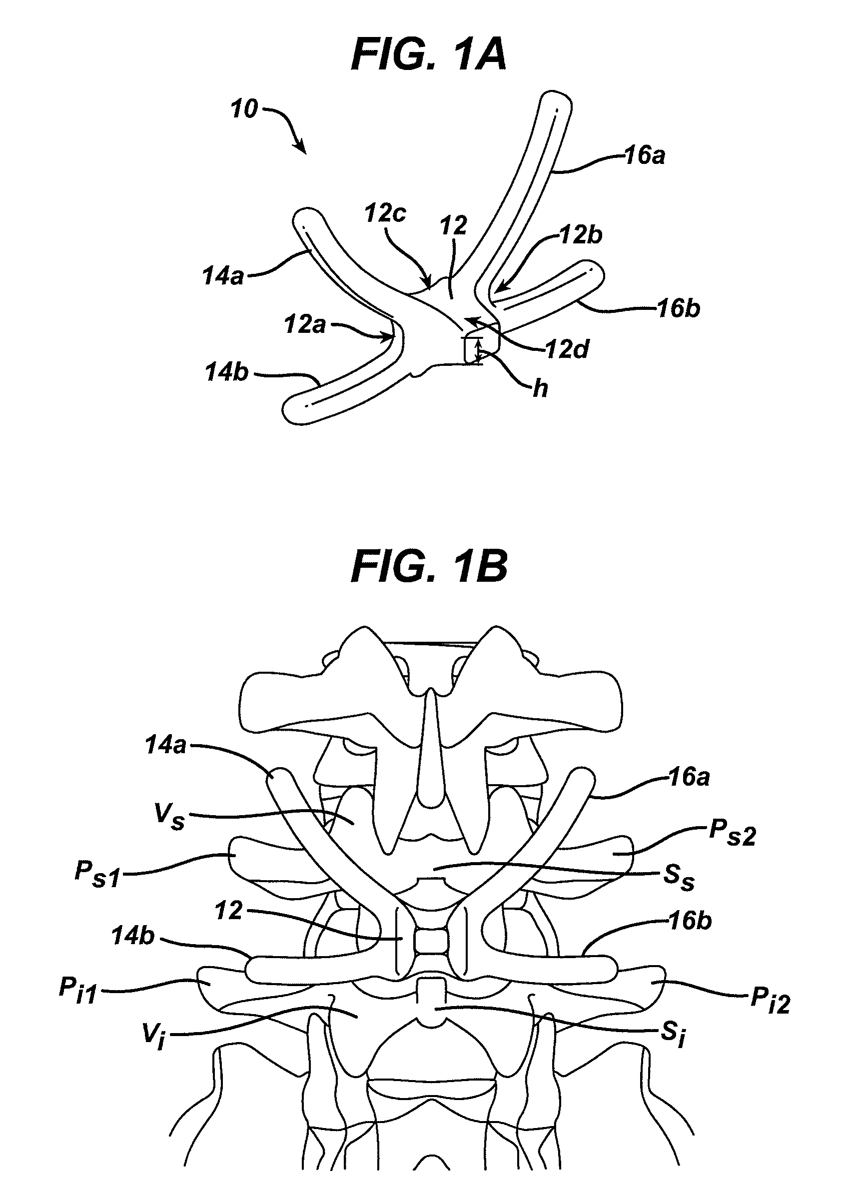 Posterior dynamic stabilization x-device