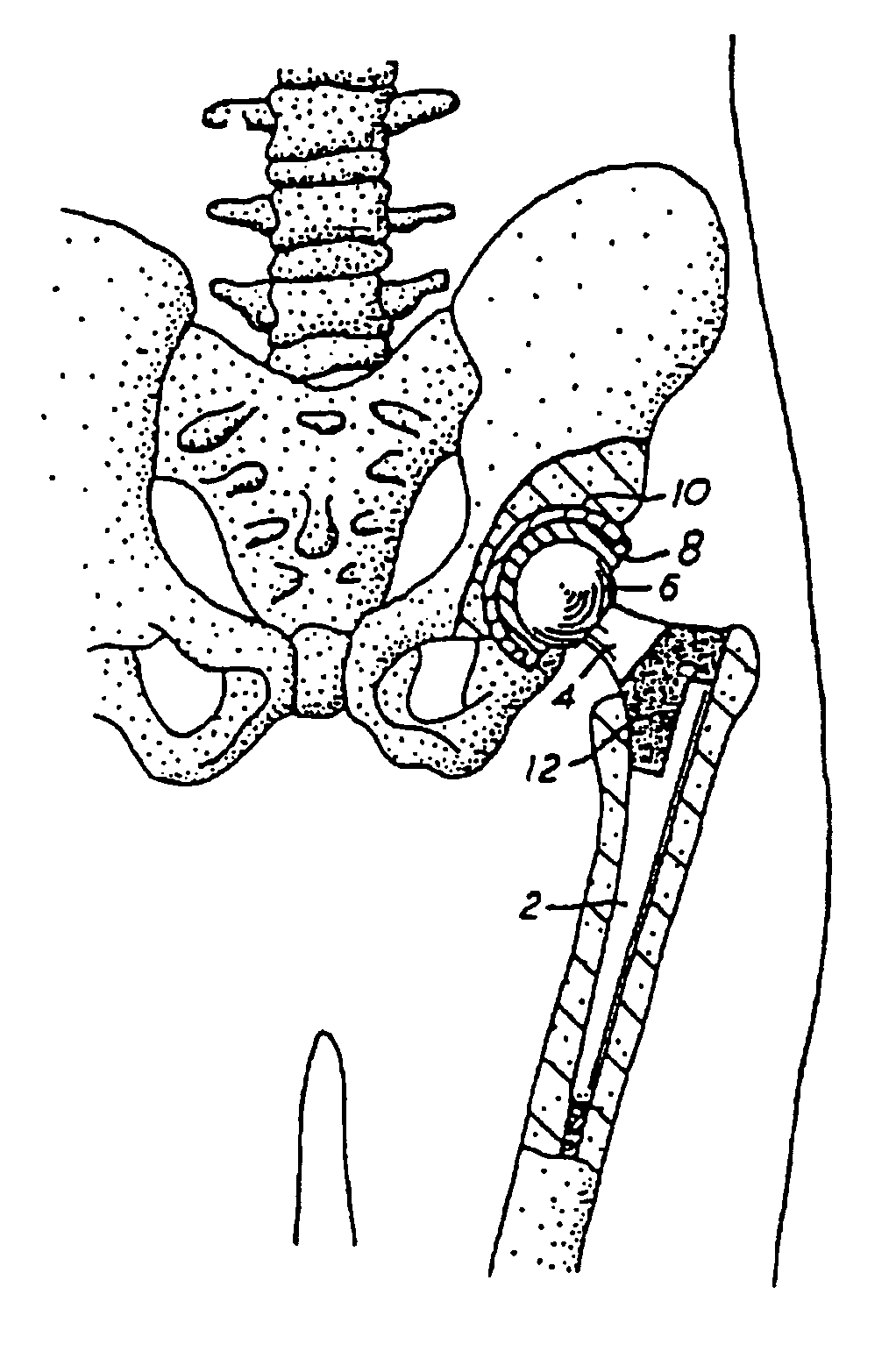 Method of surface oxidizing zirconium and zirconium alloys and resulting product