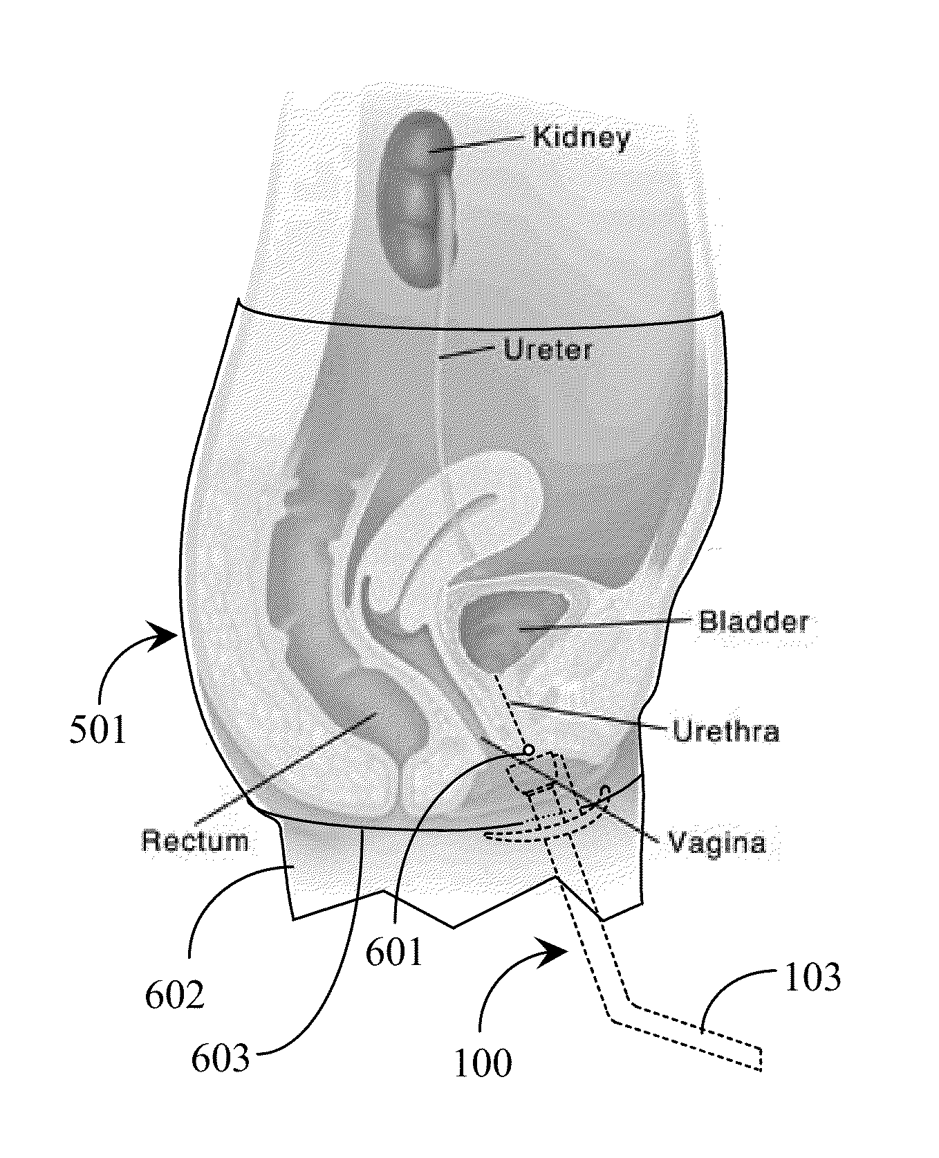 Garments for Use with Urinary Device