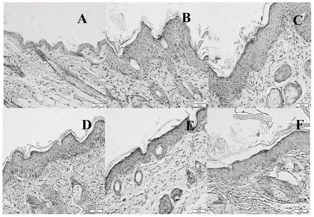 Application of monoclonal antibody in treating psoriasis