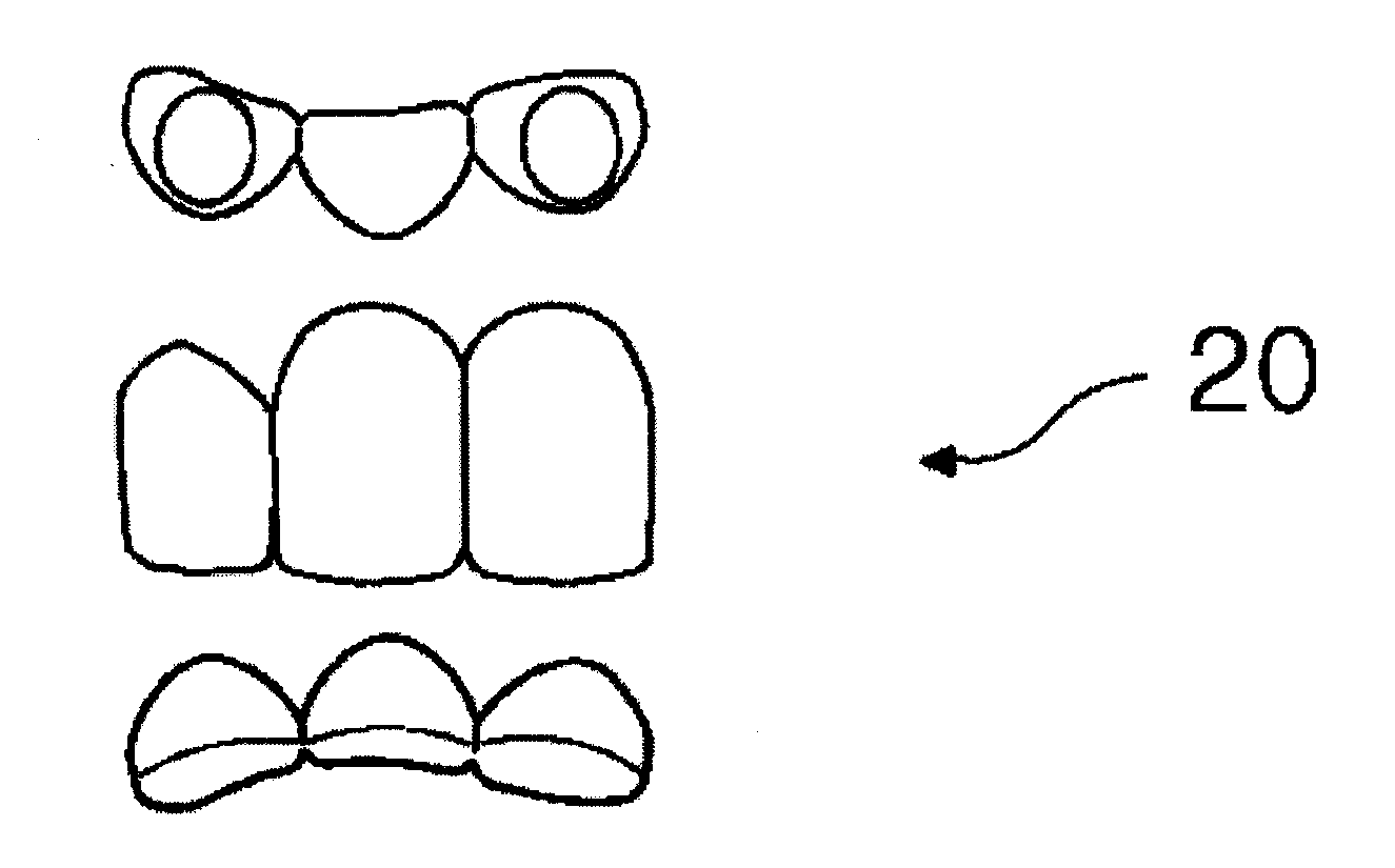 Temporary tooth bridge using veneer shell plate